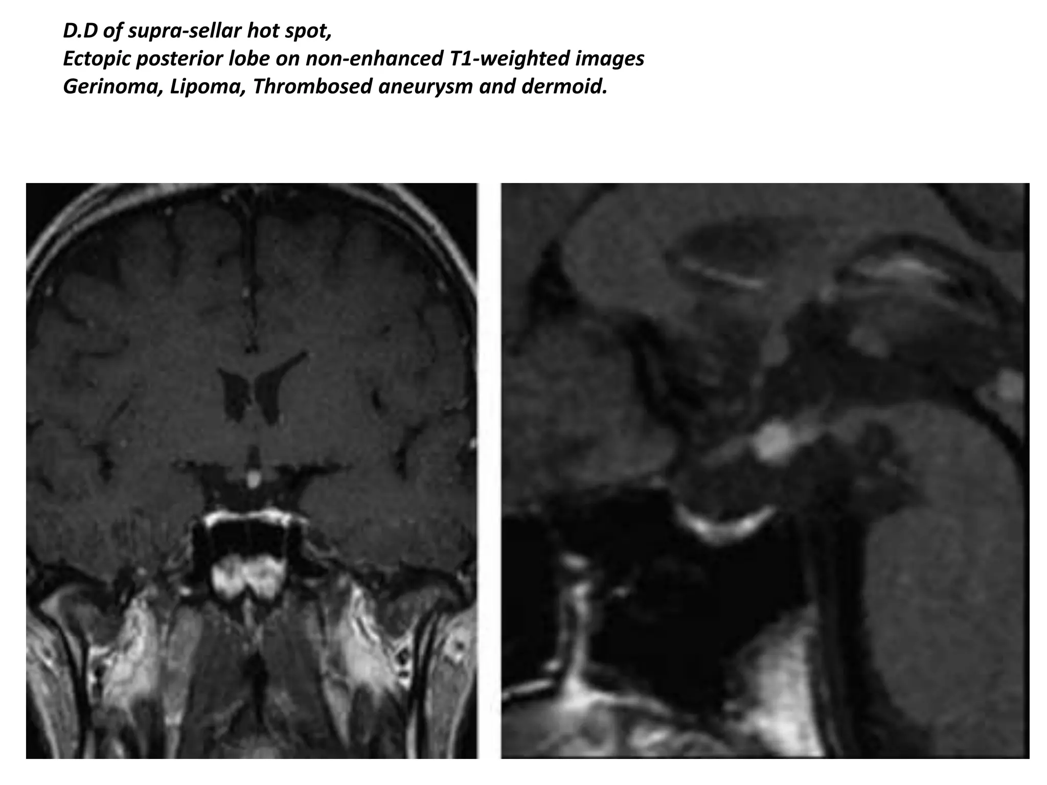D.D of supra-sellar hot spot,
Ectopic posterior lobe on non-enhanced T1-weighted images
Gerinoma, Lipoma, Thrombosed aneurysm and dermoid.

 