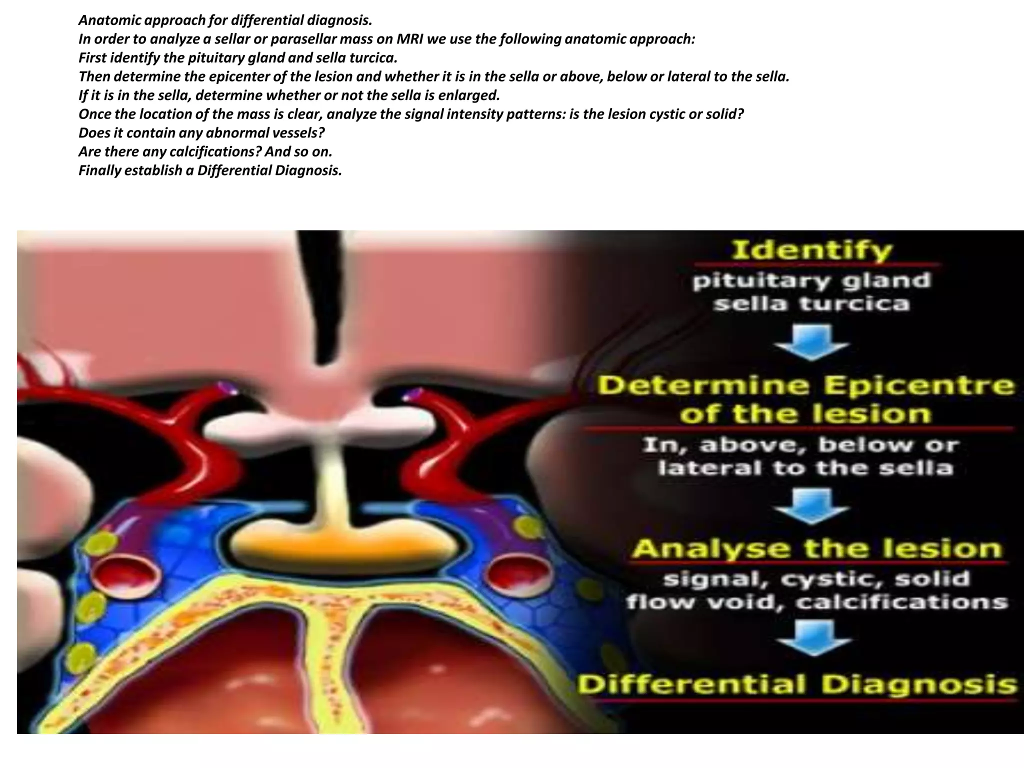 Anatomic approach for differential diagnosis.
In order to analyze a sellar or parasellar mass on MRI we use the following anatomic approach:
First identify the pituitary gland and sella turcica.
Then determine the epicenter of the lesion and whether it is in the sella or above, below or lateral to the sella.
If it is in the sella, determine whether or not the sella is enlarged.
Once the location of the mass is clear, analyze the signal intensity patterns: is the lesion cystic or solid?
Does it contain any abnormal vessels?
Are there any calcifications? And so on.
Finally establish a Differential Diagnosis.

 