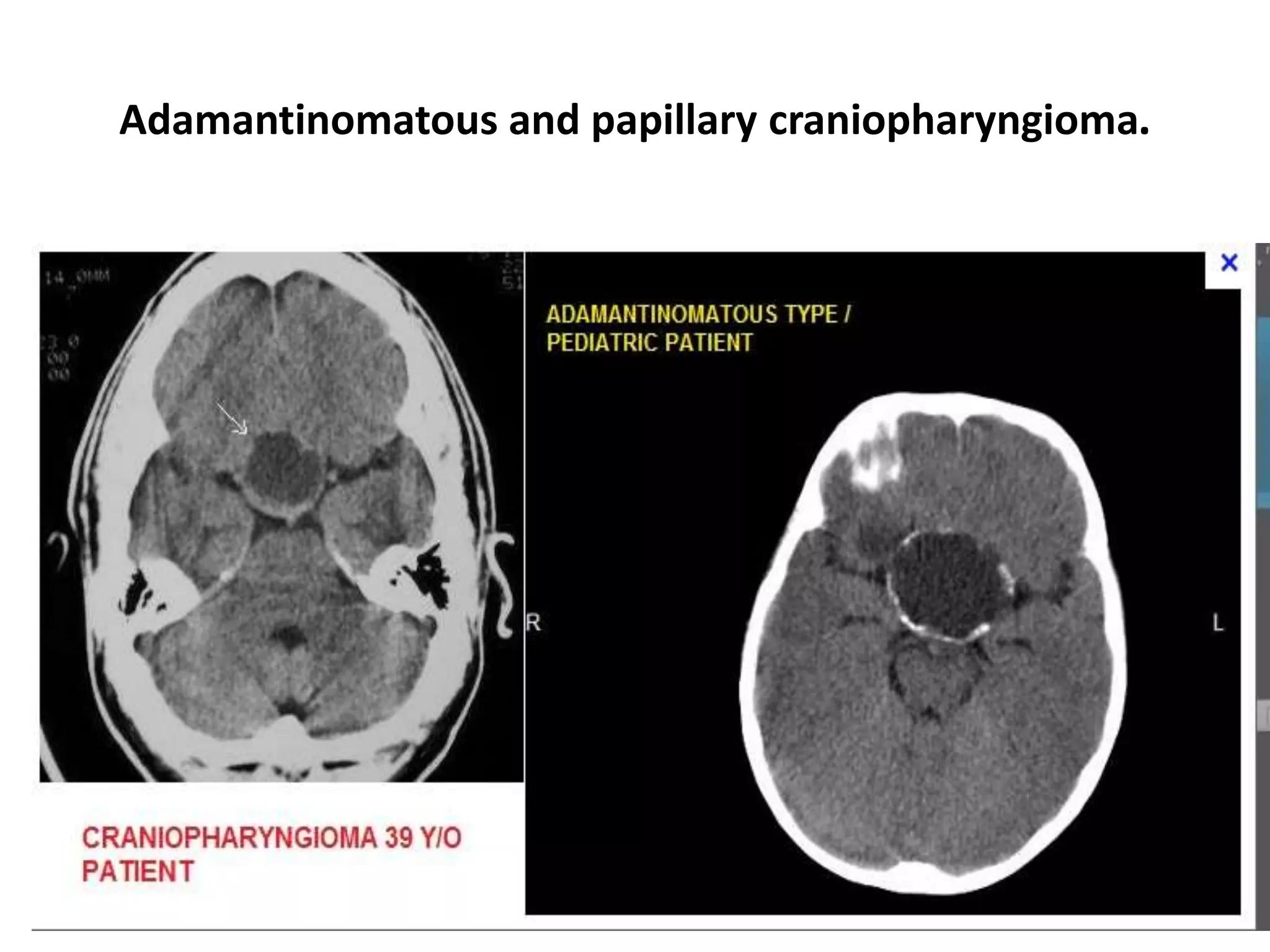 Adamantinomatous and papillary craniopharyngioma.

 