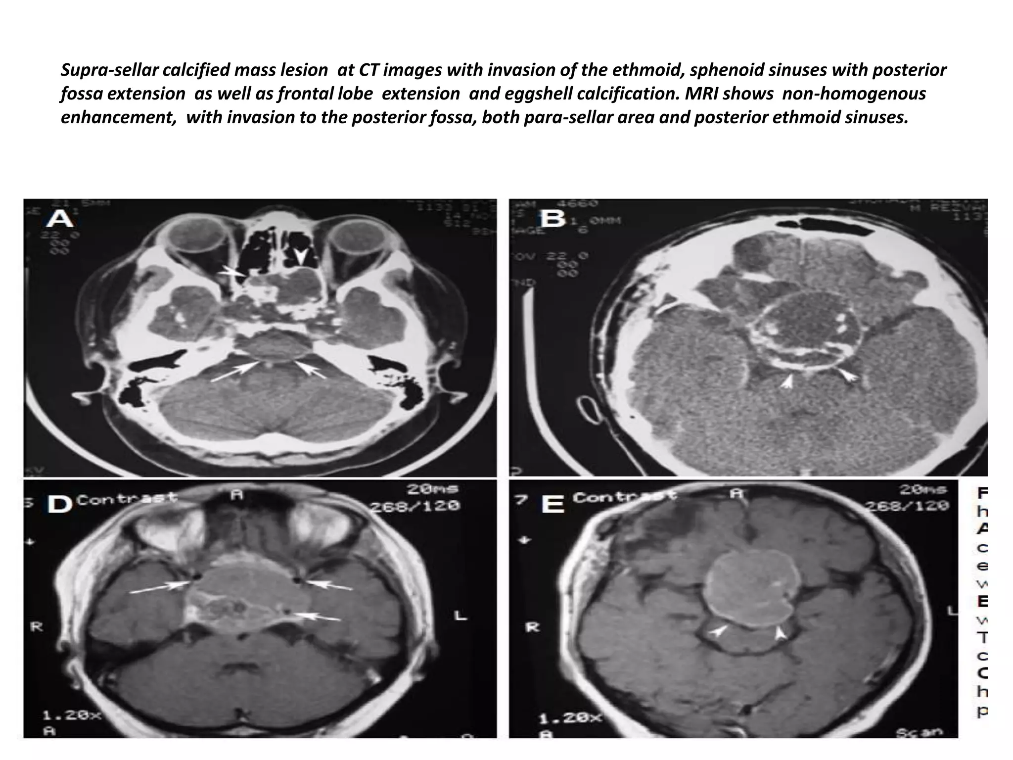 Supra-sellar calcified mass lesion at CT images with invasion of the ethmoid, sphenoid sinuses with posterior
fossa extension as well as frontal lobe extension and eggshell calcification. MRI shows non-homogenous
enhancement, with invasion to the posterior fossa, both para-sellar area and posterior ethmoid sinuses.

 