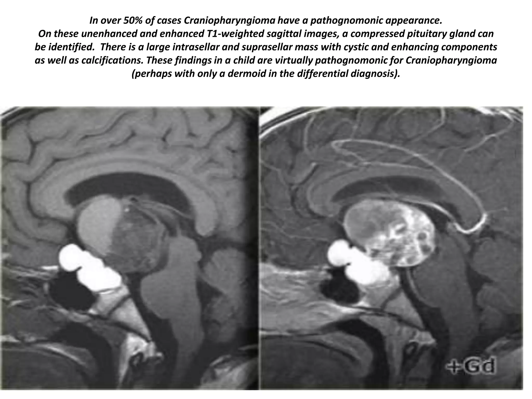 In over 50% of cases Craniopharyngioma have a pathognomonic appearance.
On these unenhanced and enhanced T1-weighted sagittal images, a compressed pituitary gland can
be identified. There is a large intrasellar and suprasellar mass with cystic and enhancing components
as well as calcifications. These findings in a child are virtually pathognomonic for Craniopharyngioma
(perhaps with only a dermoid in the differential diagnosis).

 