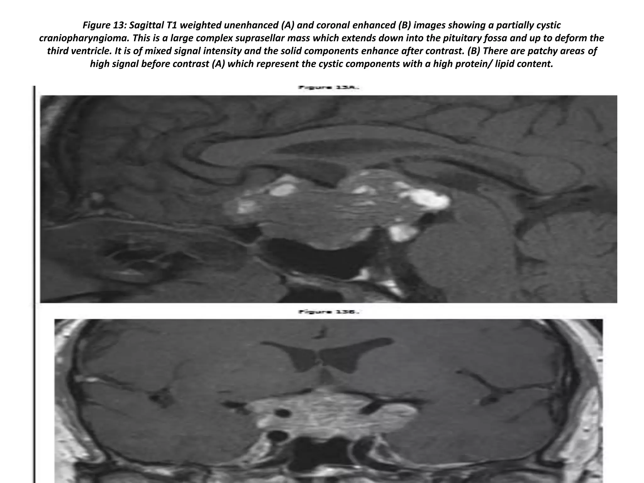 Figure 13: Sagittal T1 weighted unenhanced (A) and coronal enhanced (B) images showing a partially cystic
craniopharyngioma. This is a large complex suprasellar mass which extends down into the pituitary fossa and up to deform the
third ventricle. It is of mixed signal intensity and the solid components enhance after contrast. (B) There are patchy areas of
high signal before contrast (A) which represent the cystic components with a high protein/ lipid content.

 