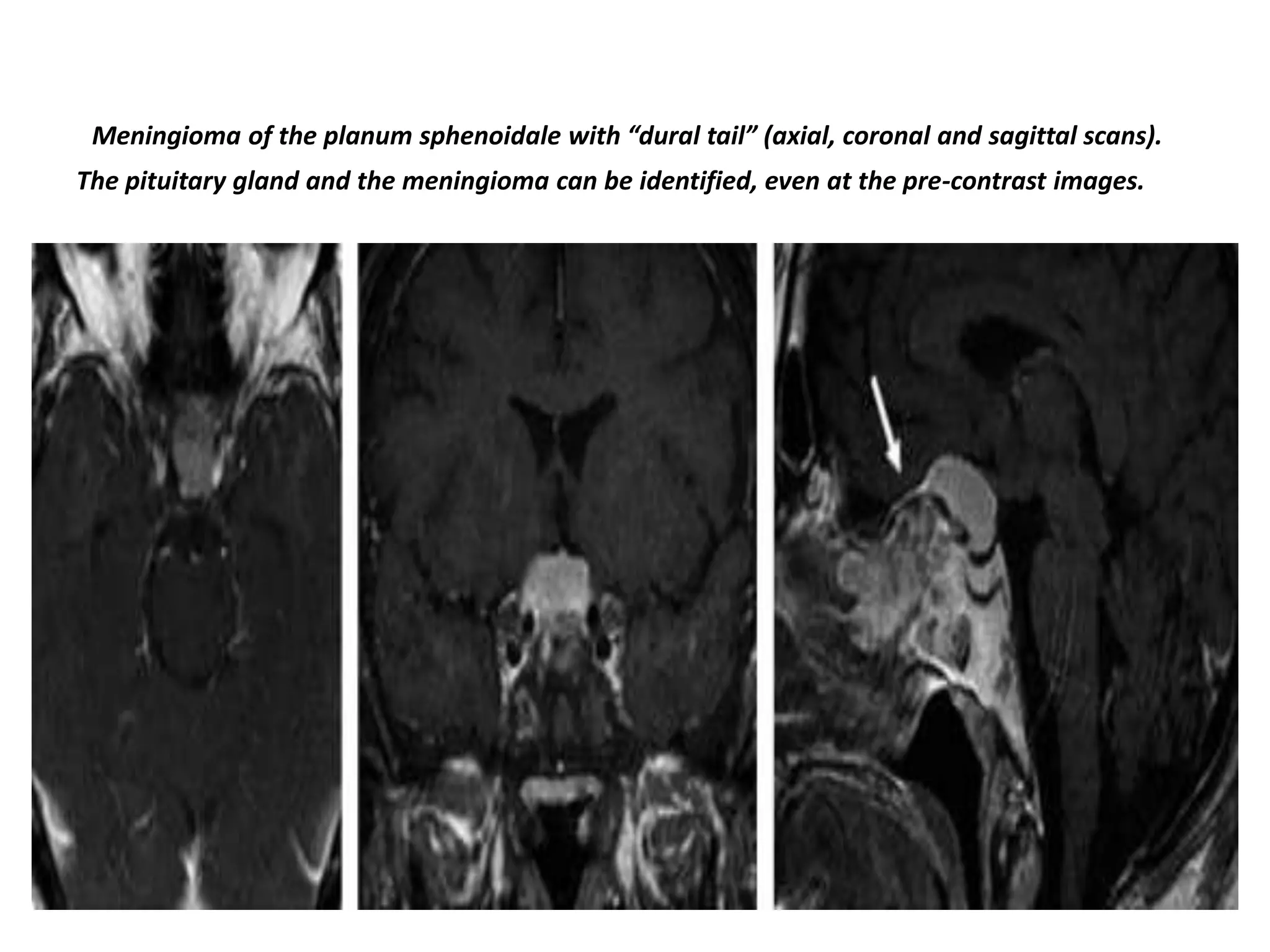 Meningioma of the planum sphenoidale with “dural tail” (axial, coronal and sagittal scans).
The pituitary gland and the meningioma can be identified, even at the pre-contrast images.

 