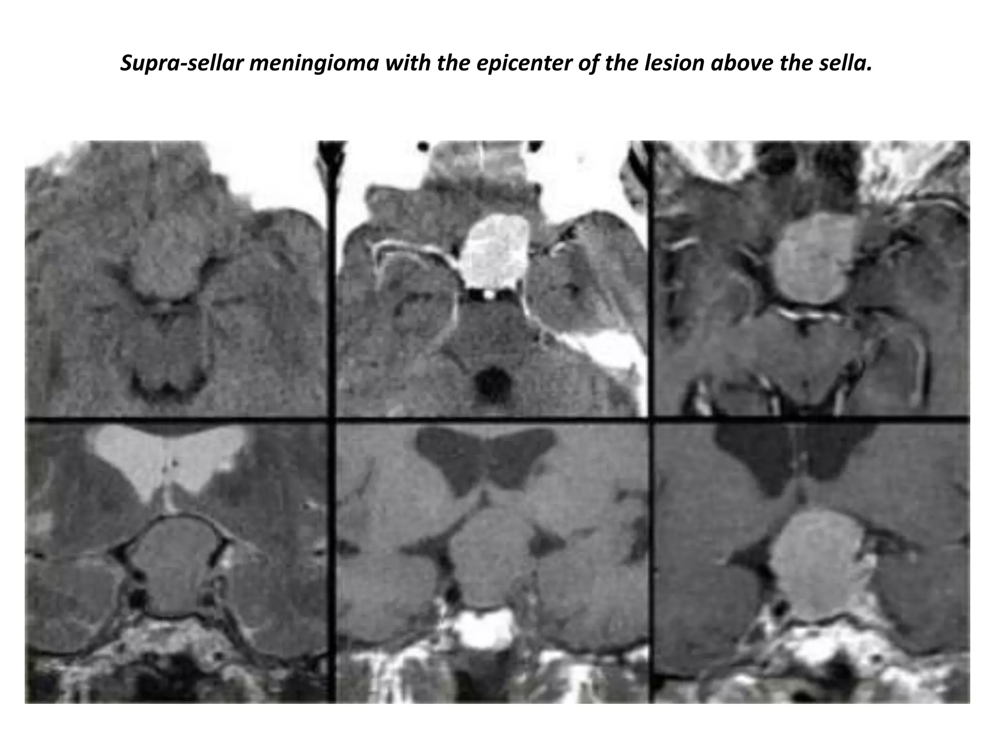 Supra-sellar meningioma with the epicenter of the lesion above the sella.

 