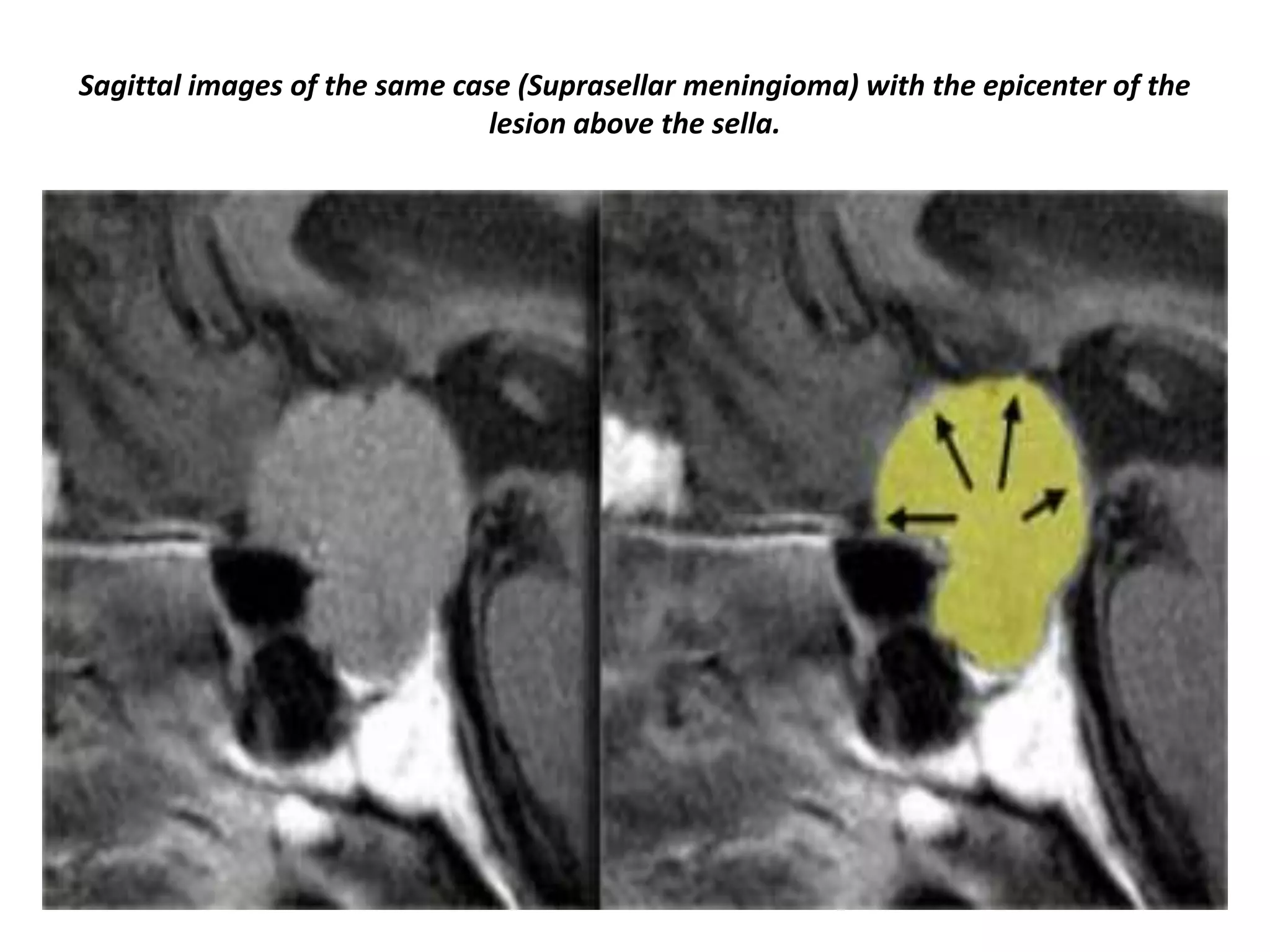 Sagittal images of the same case (Suprasellar meningioma) with the epicenter of the
lesion above the sella.

 