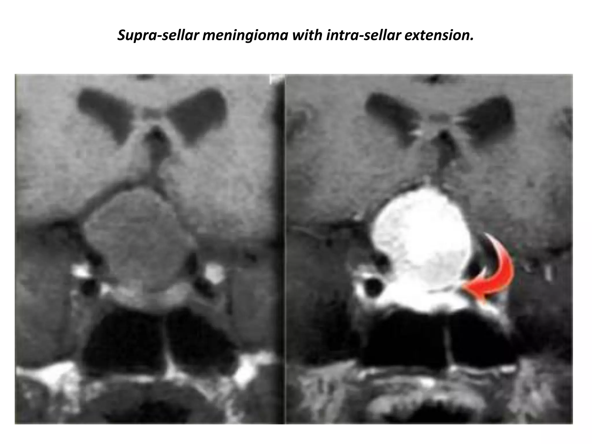 Supra-sellar meningioma with intra-sellar extension.

 
