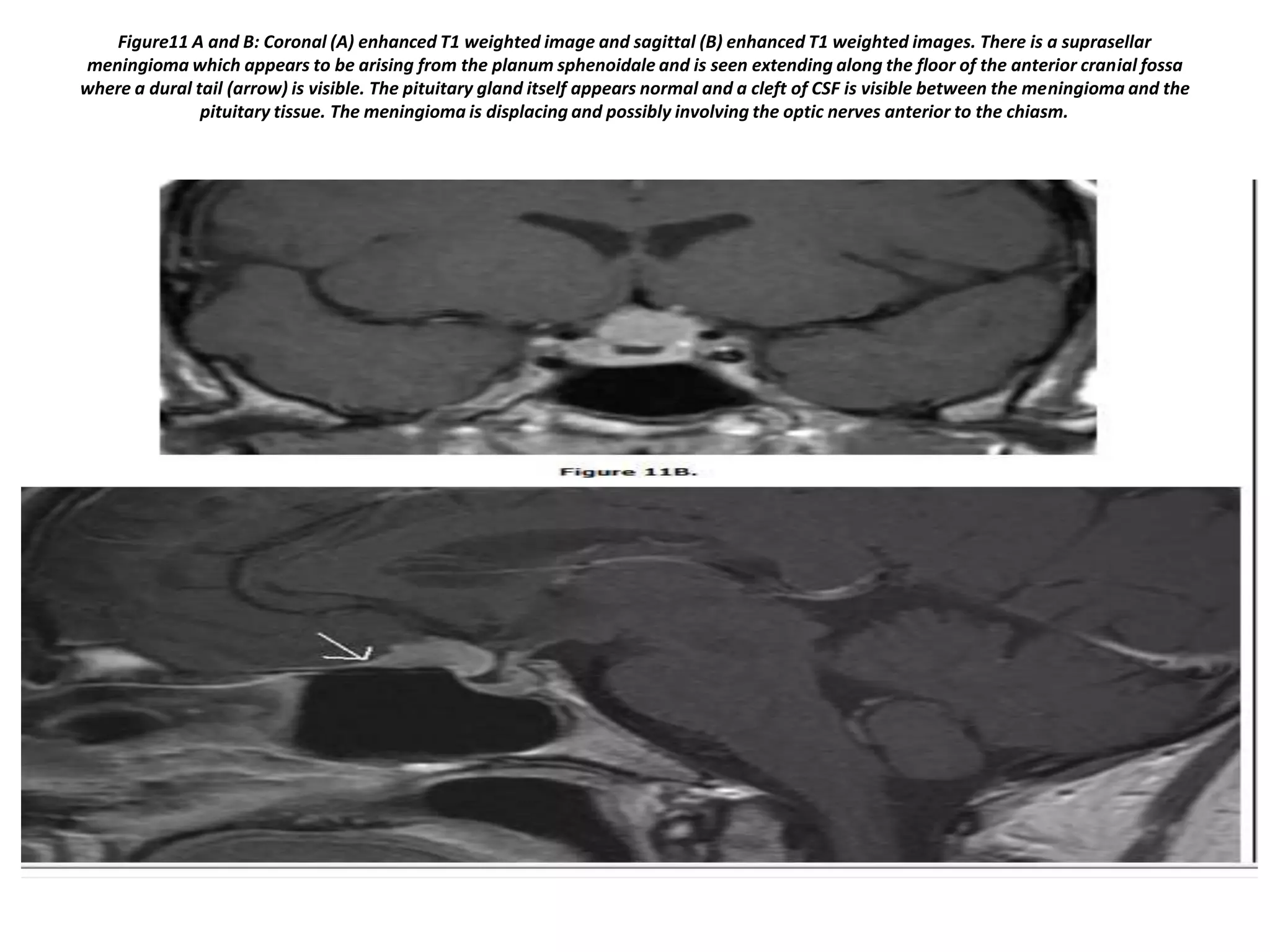 Figure11 A and B: Coronal (A) enhanced T1 weighted image and sagittal (B) enhanced T1 weighted images. There is a suprasellar
meningioma which appears to be arising from the planum sphenoidale and is seen extending along the floor of the anterior cranial fossa
where a dural tail (arrow) is visible. The pituitary gland itself appears normal and a cleft of CSF is visible between the meningioma and the
pituitary tissue. The meningioma is displacing and possibly involving the optic nerves anterior to the chiasm.

 
