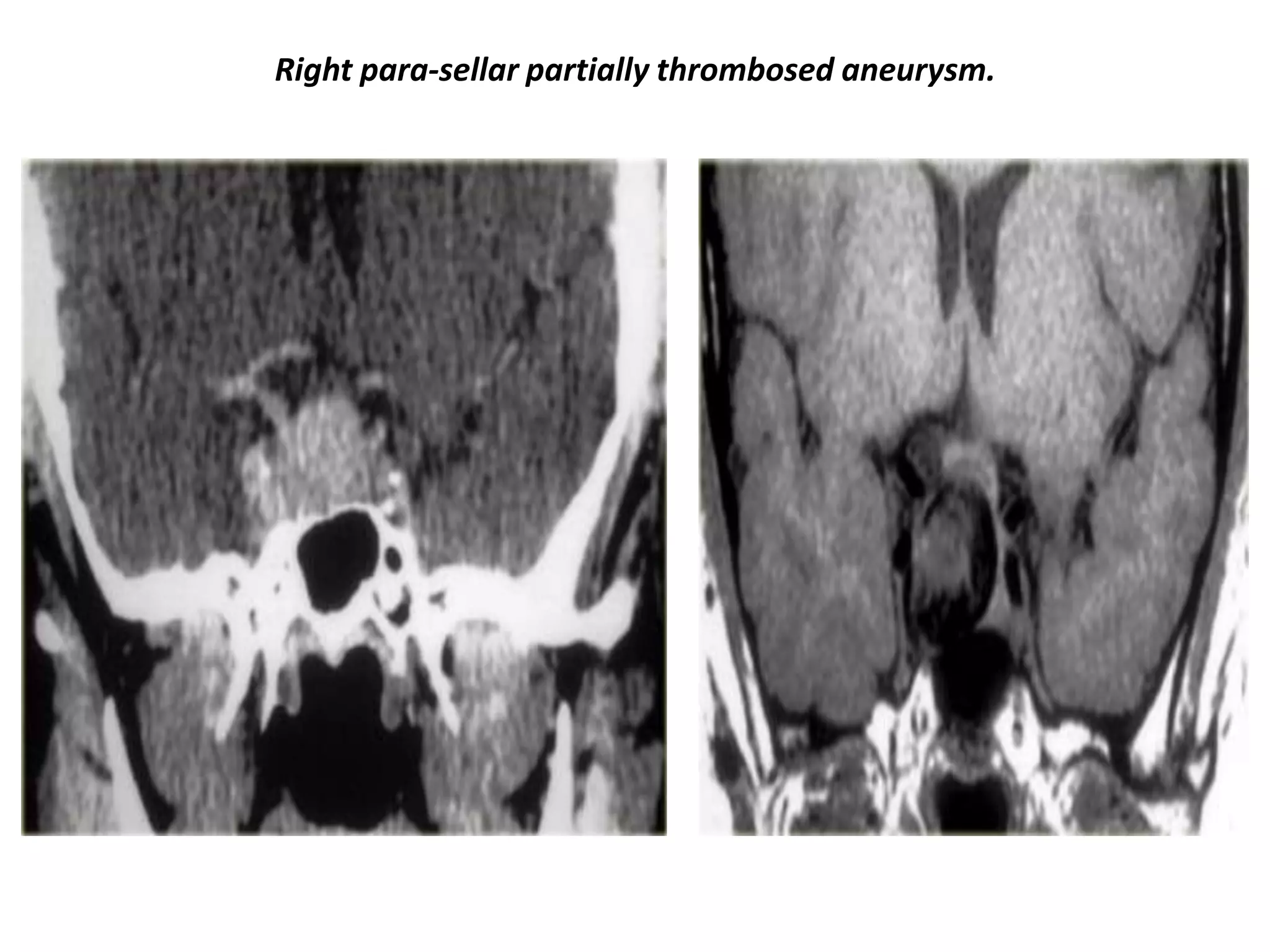 Right para-sellar partially thrombosed aneurysm.

 