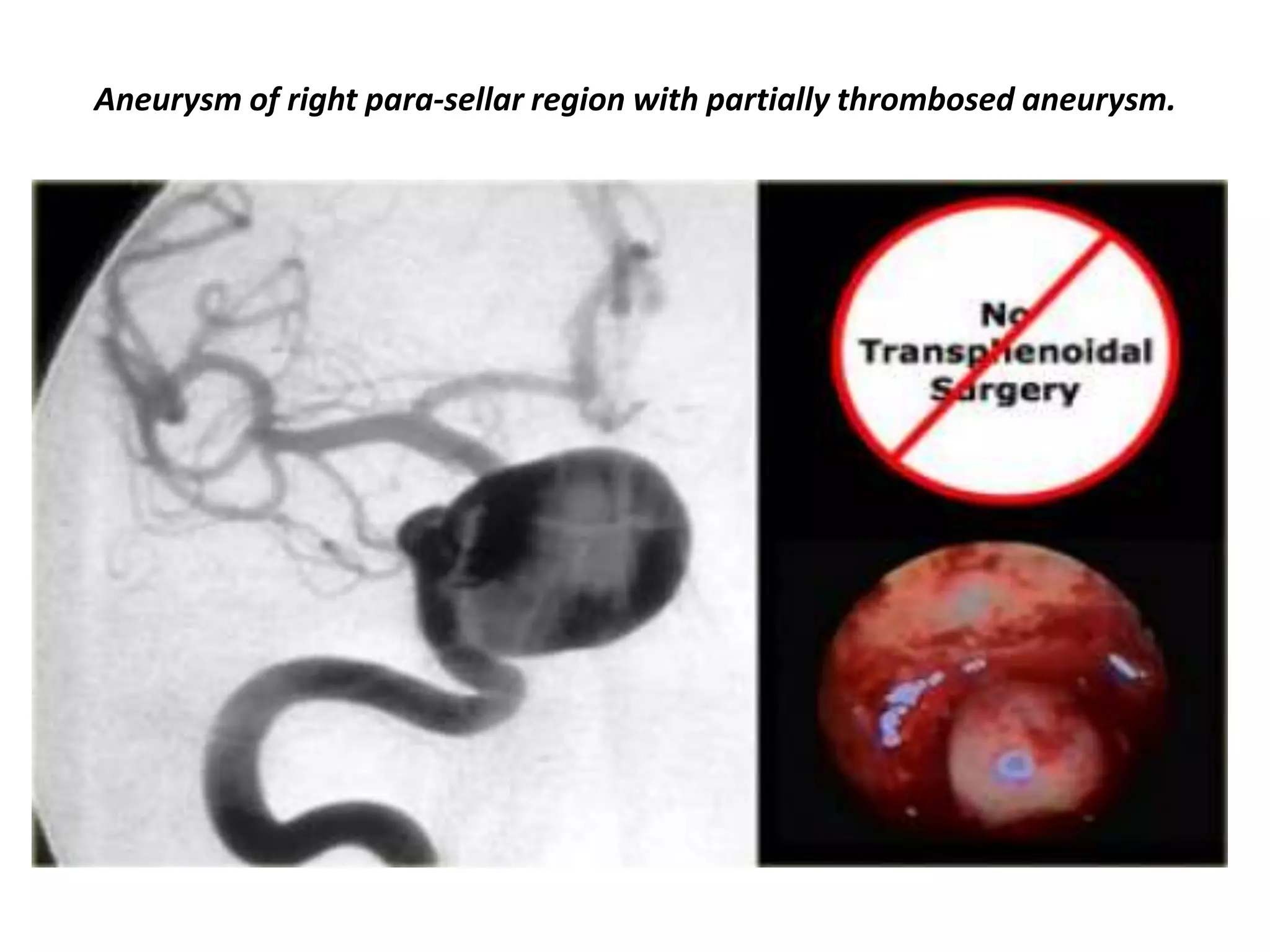 Aneurysm of right para-sellar region with partially thrombosed aneurysm.

 