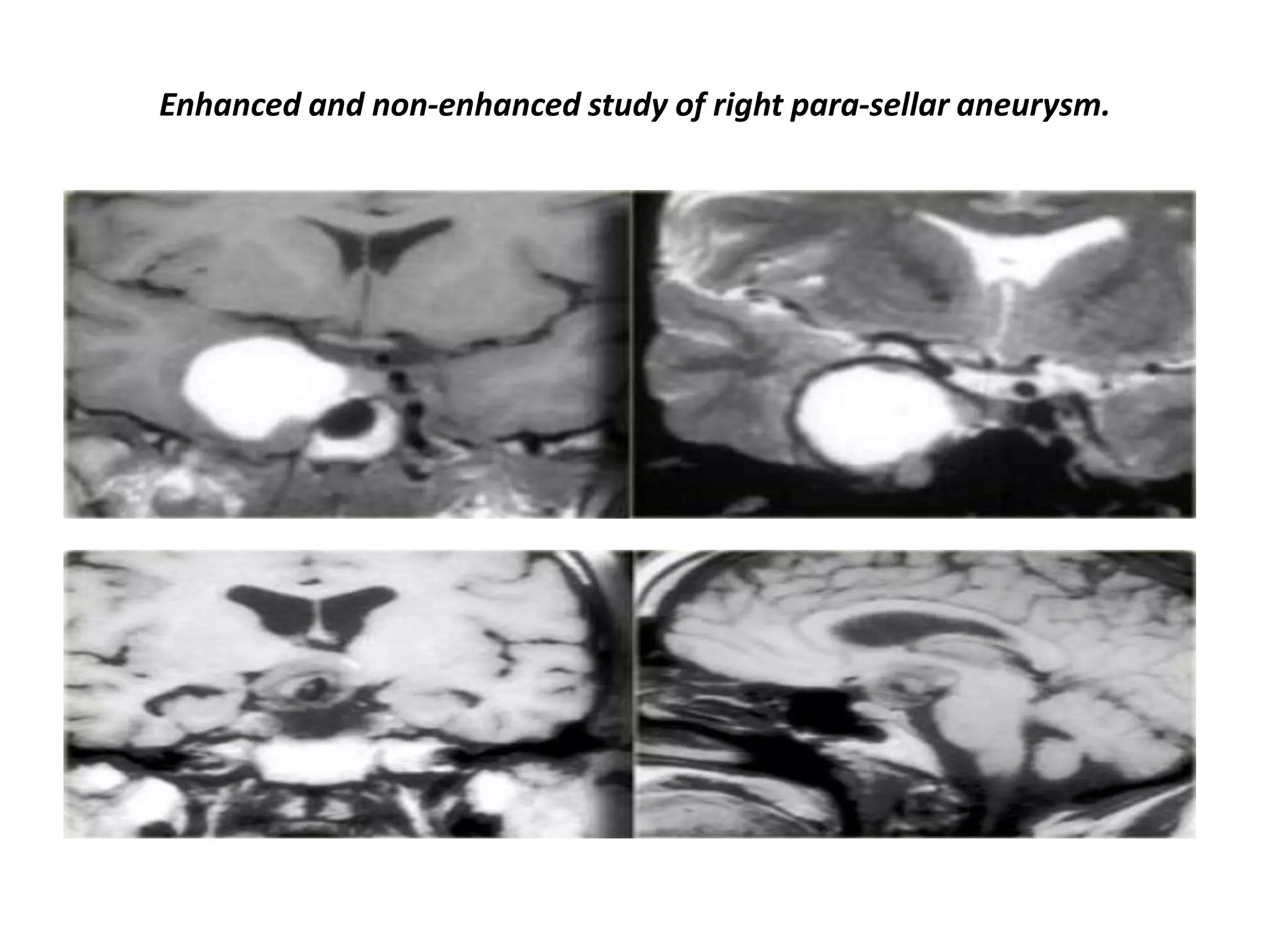 Enhanced and non-enhanced study of right para-sellar aneurysm.

 