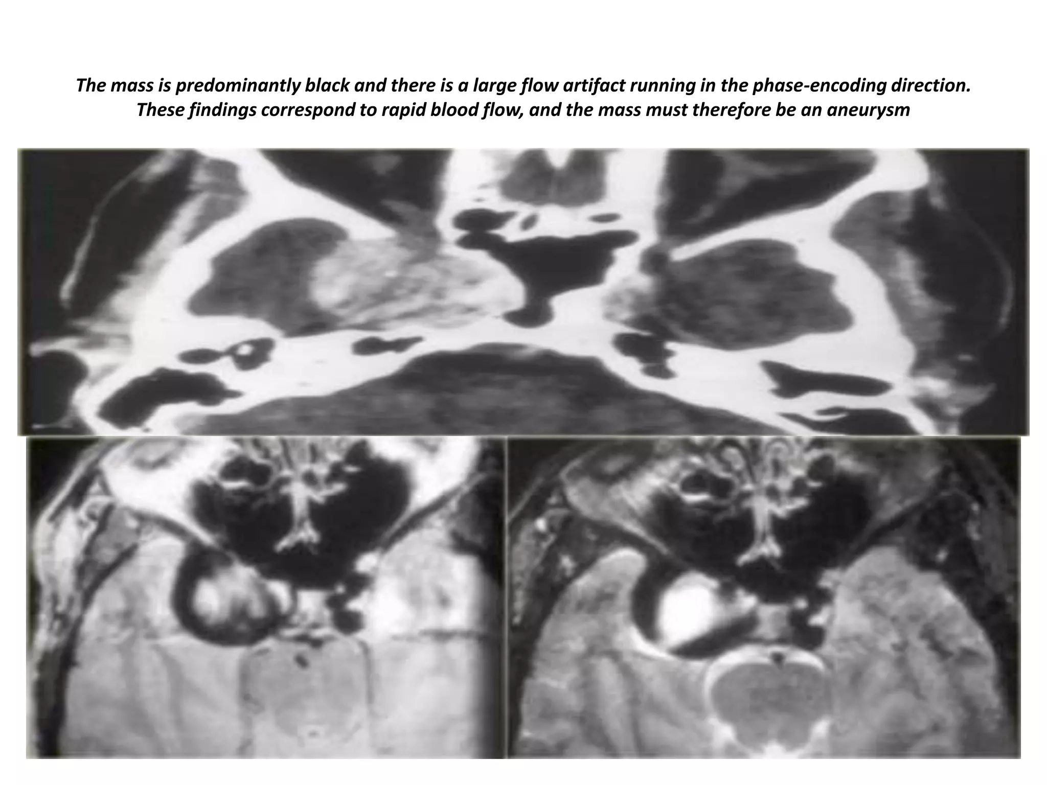 The mass is predominantly black and there is a large flow artifact running in the phase-encoding direction.
These findings correspond to rapid blood flow, and the mass must therefore be an aneurysm

 