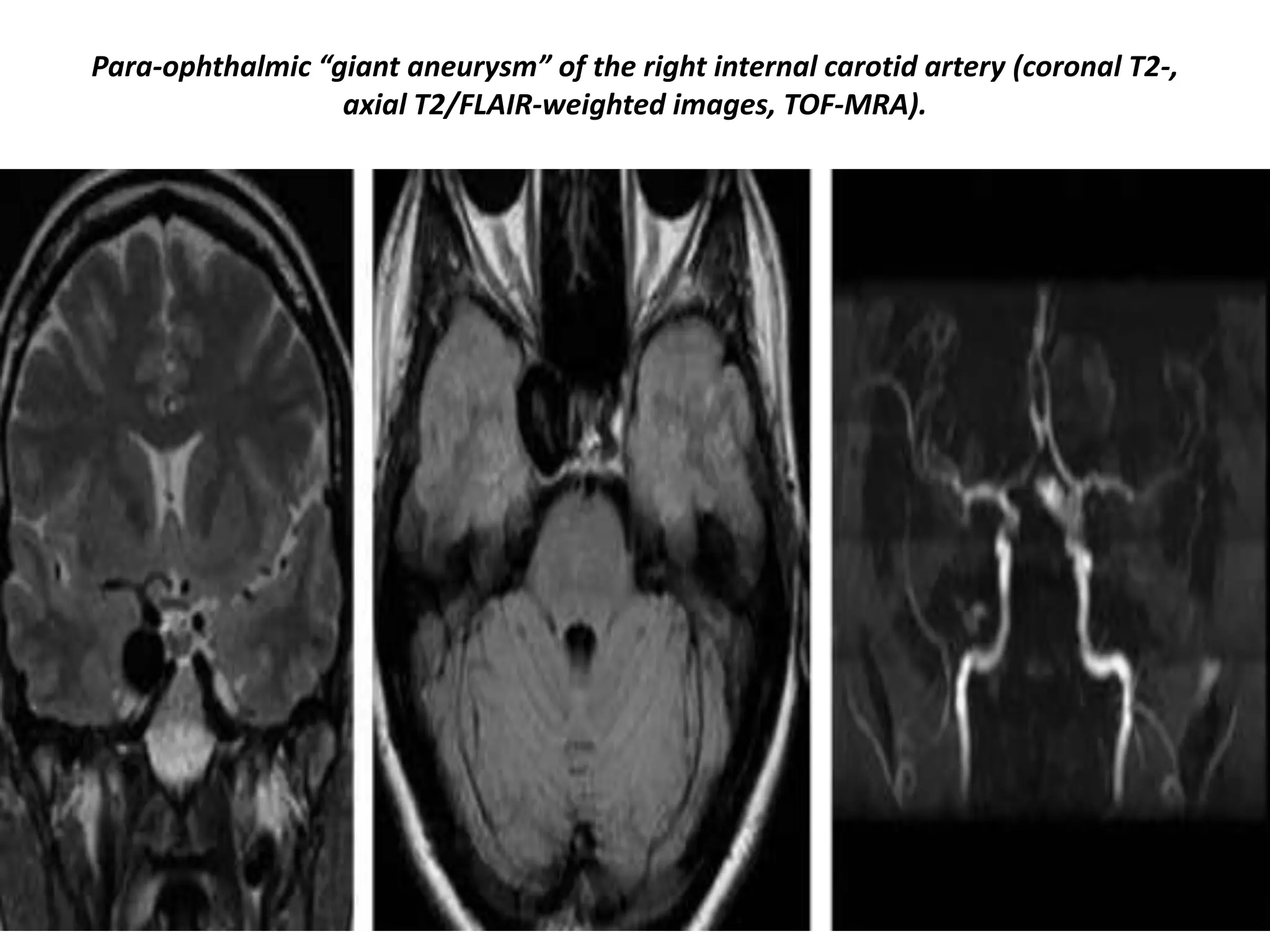 Para-ophthalmic “giant aneurysm” of the right internal carotid artery (coronal T2-,
axial T2/FLAIR-weighted images, TOF-MRA).

 