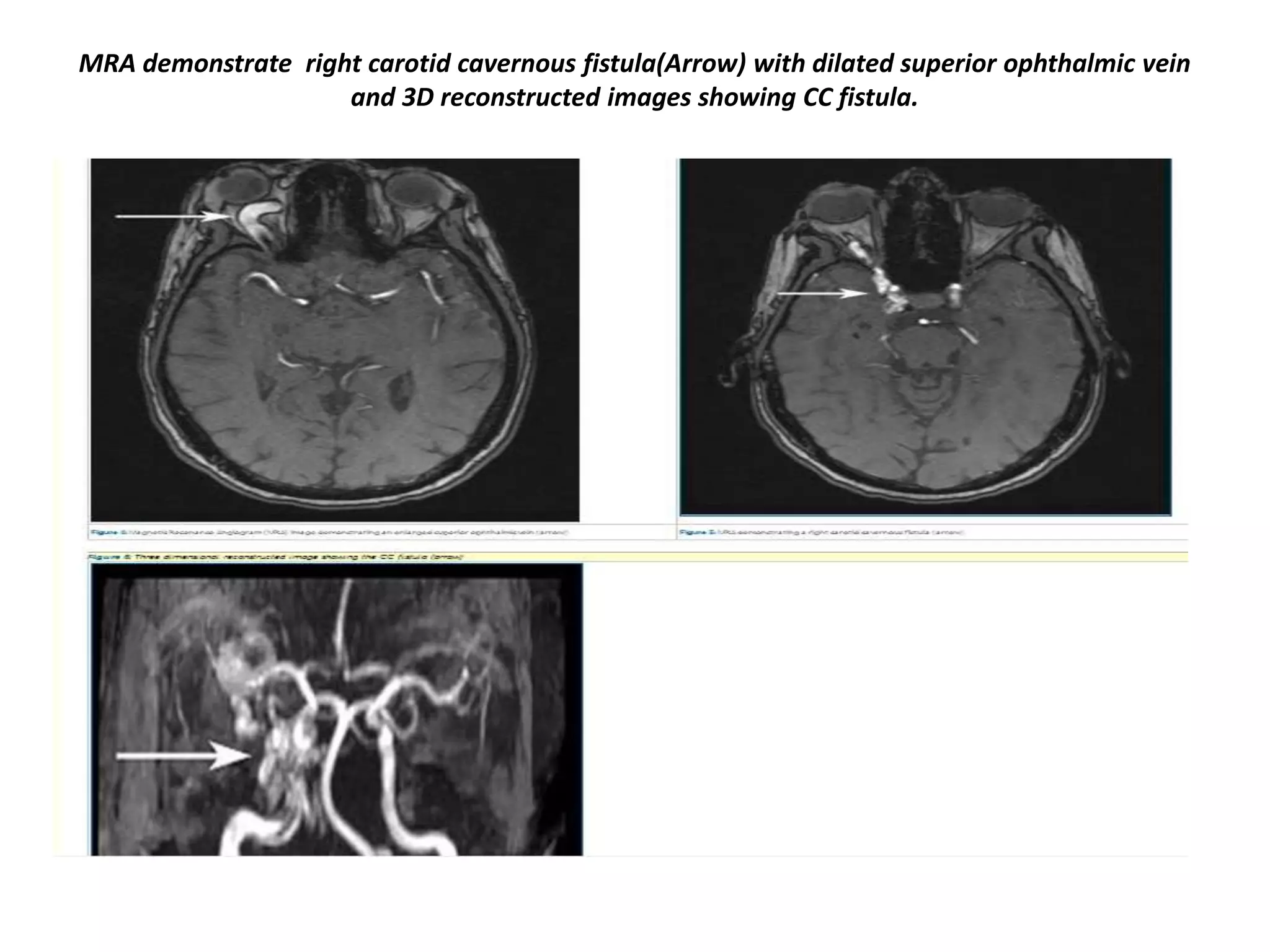 MRA demonstrate right carotid cavernous fistula(Arrow) with dilated superior ophthalmic vein
and 3D reconstructed images showing CC fistula.

 