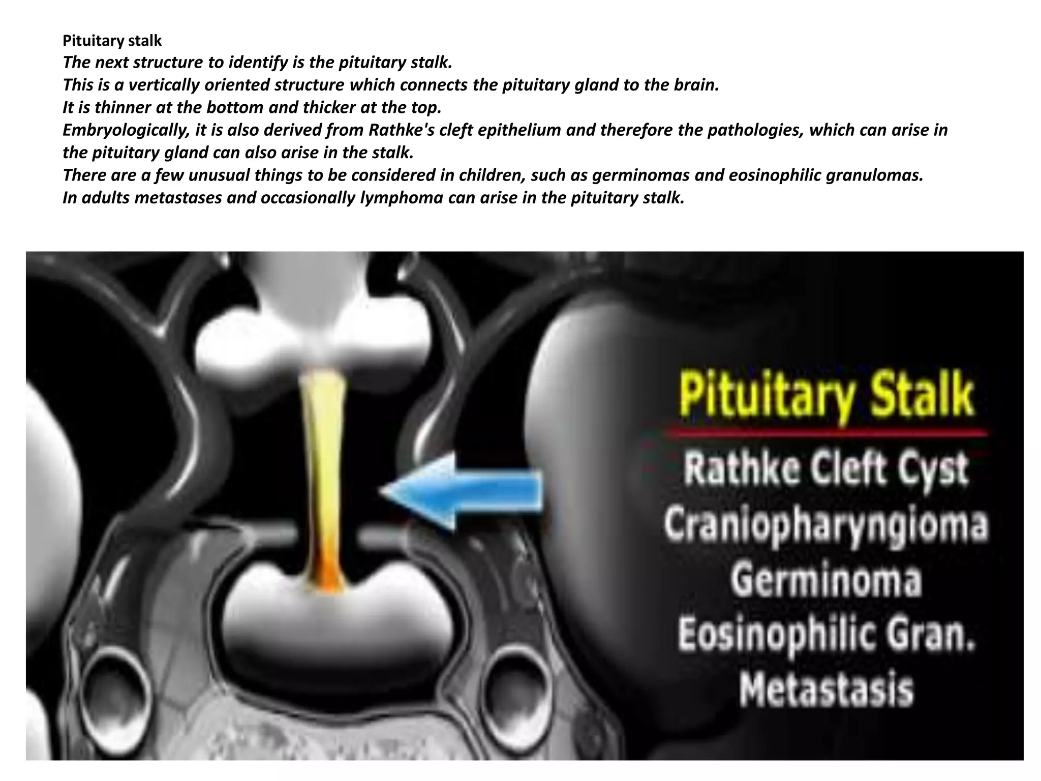 Pituitary stalk

The next structure to identify is the pituitary stalk.
This is a vertically oriented structure which connects the pituitary gland to the brain.
It is thinner at the bottom and thicker at the top.
Embryologically, it is also derived from Rathke's cleft epithelium and therefore the pathologies, which can arise in
the pituitary gland can also arise in the stalk.
There are a few unusual things to be considered in children, such as germinomas and eosinophilic granulomas.
In adults metastases and occasionally lymphoma can arise in the pituitary stalk.

 