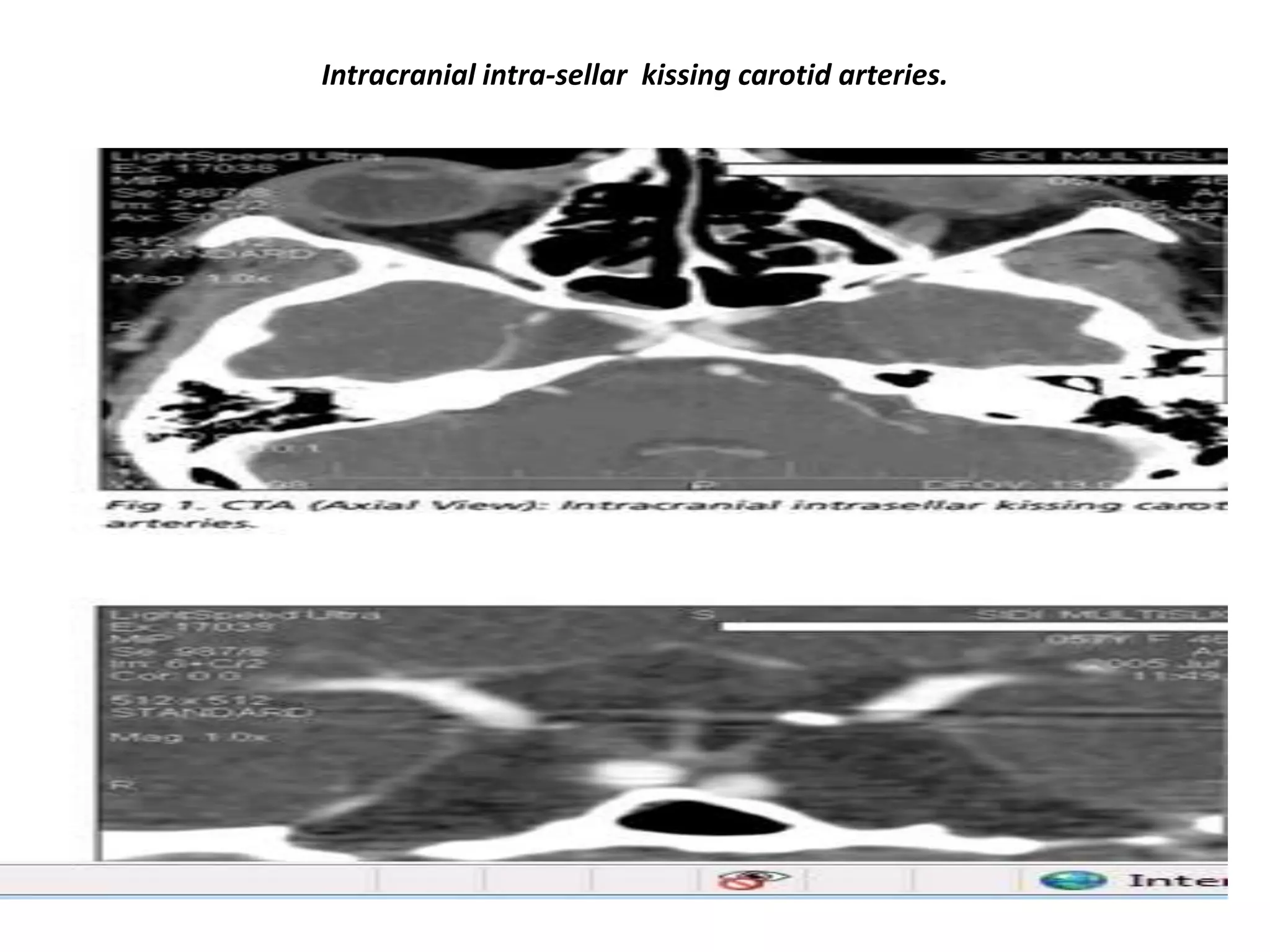 Intracranial intra-sellar kissing carotid arteries.

 