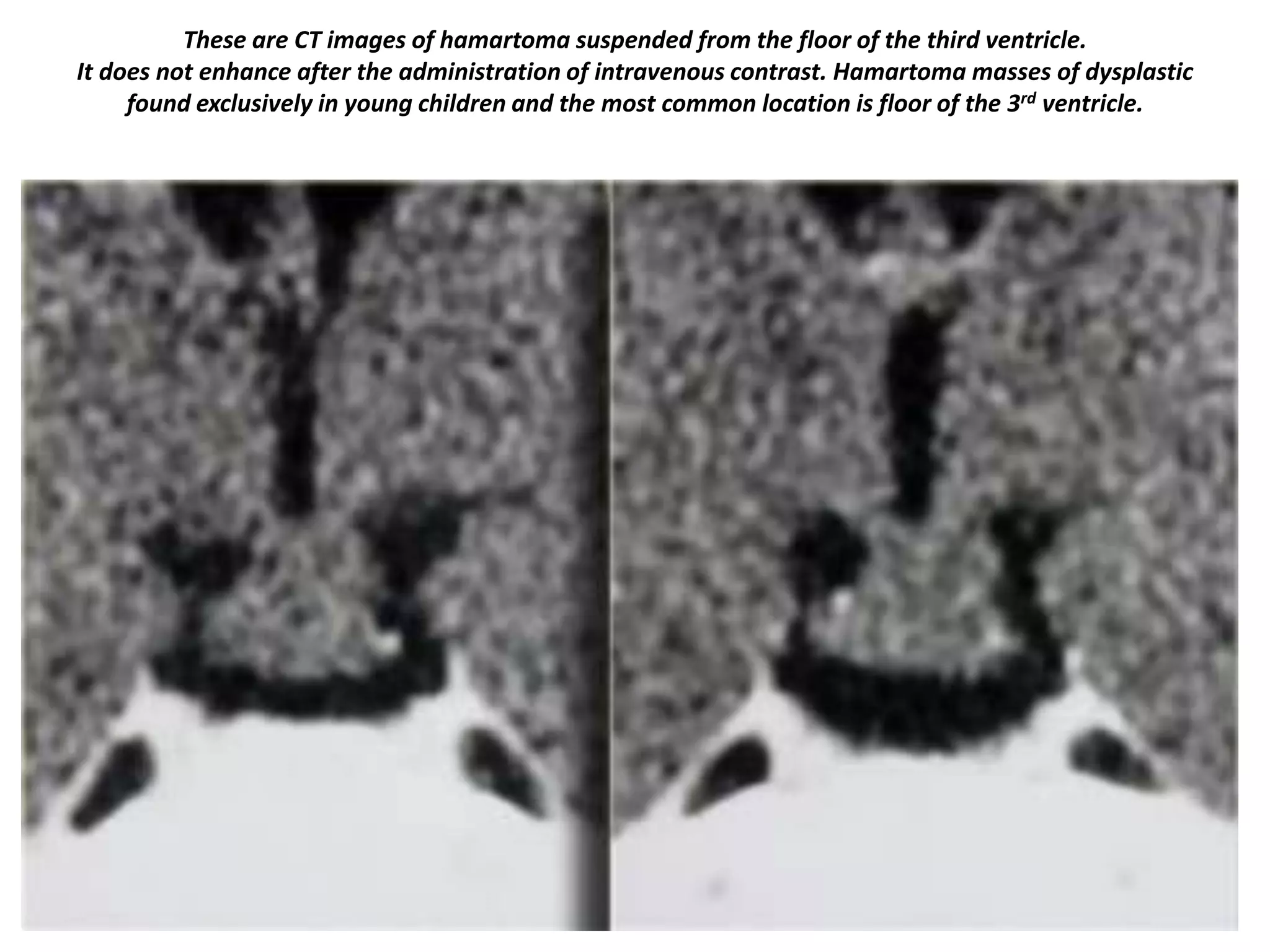 These are CT images of hamartoma suspended from the floor of the third ventricle.
It does not enhance after the administration of intravenous contrast. Hamartoma masses of dysplastic
found exclusively in young children and the most common location is floor of the 3rd ventricle.

 