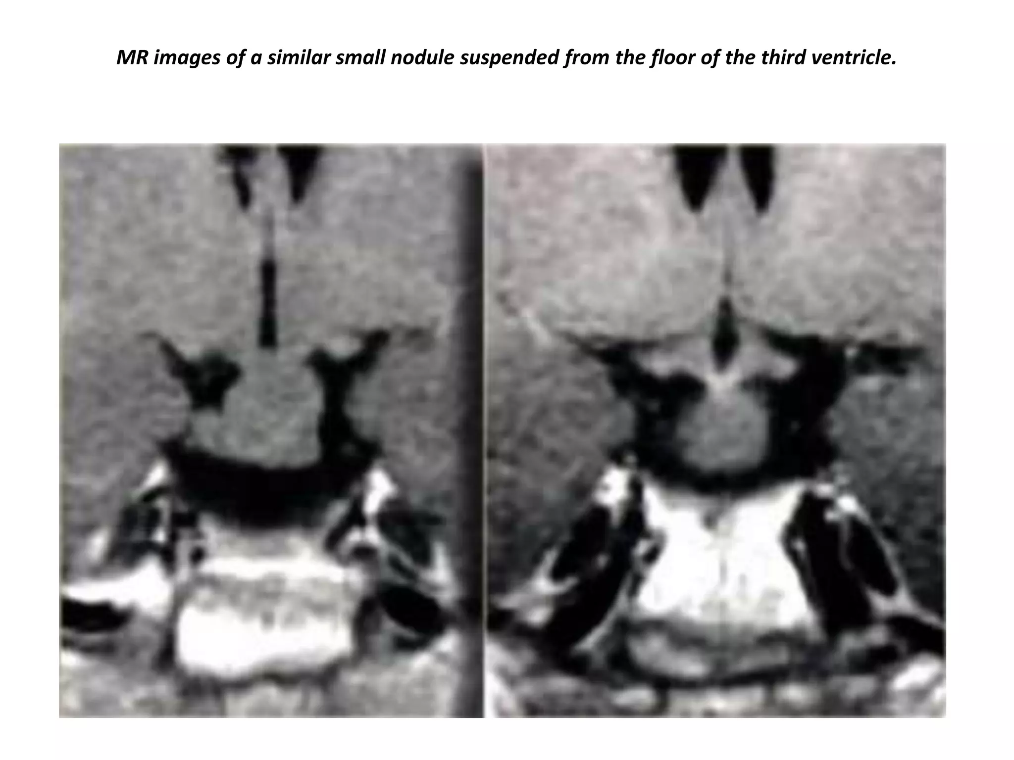 MR images of a similar small nodule suspended from the floor of the third ventricle.

 