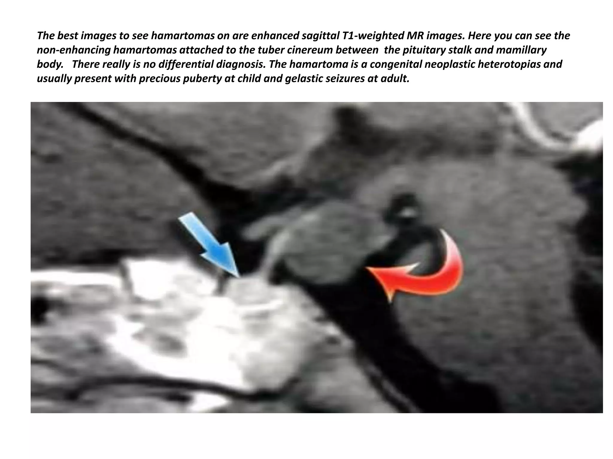 The best images to see hamartomas on are enhanced sagittal T1-weighted MR images. Here you can see the
non-enhancing hamartomas attached to the tuber cinereum between the pituitary stalk and mamillary
body. There really is no differential diagnosis. The hamartoma is a congenital neoplastic heterotopias and
usually present with precious puberty at child and gelastic seizures at adult.

 