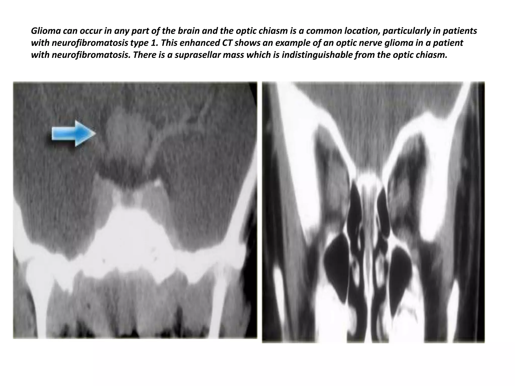 Glioma can occur in any part of the brain and the optic chiasm is a common location, particularly in patients
with neurofibromatosis type 1. This enhanced CT shows an example of an optic nerve glioma in a patient
with neurofibromatosis. There is a suprasellar mass which is indistinguishable from the optic chiasm.

 