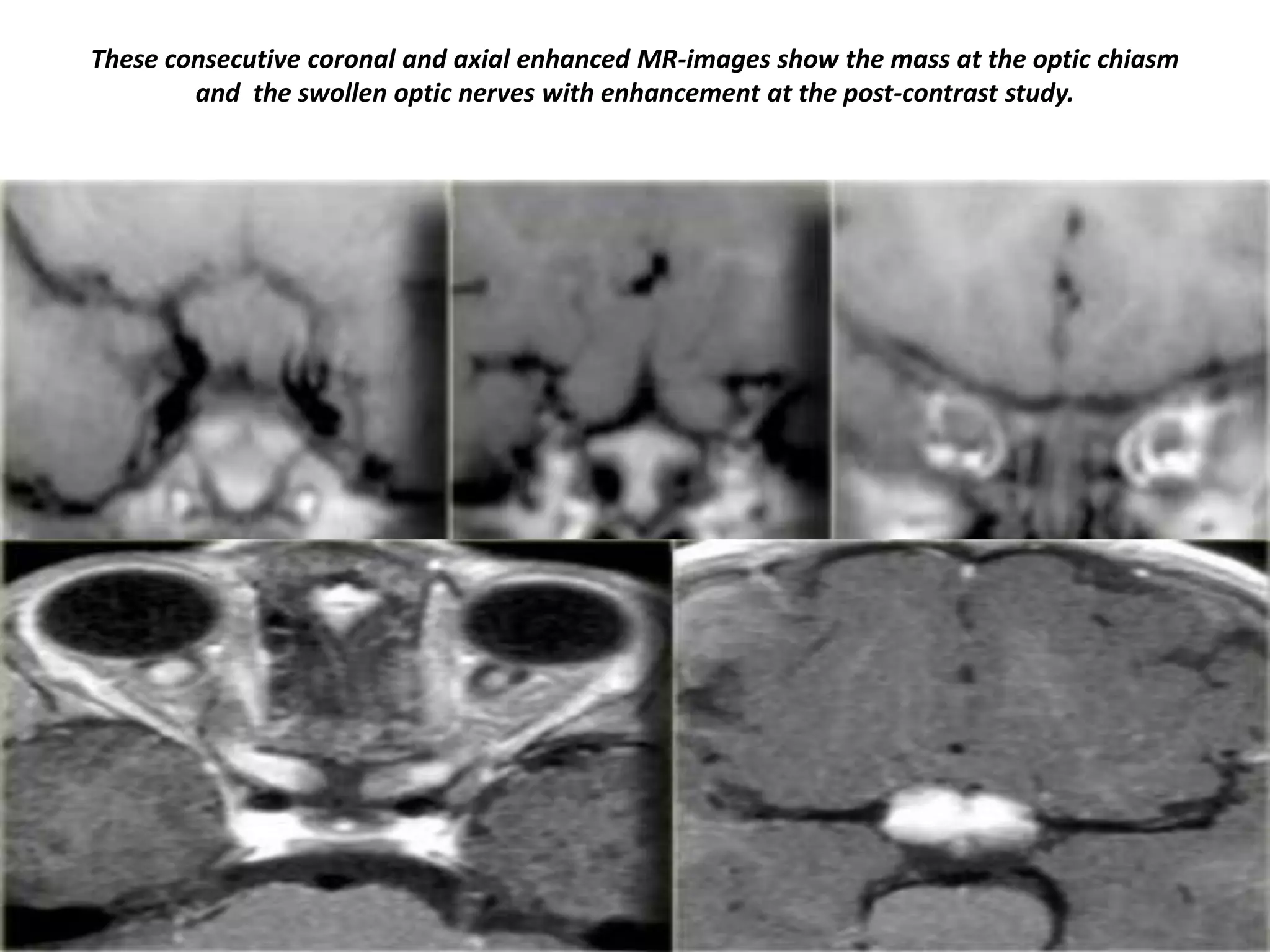 These consecutive coronal and axial enhanced MR-images show the mass at the optic chiasm
and the swollen optic nerves with enhancement at the post-contrast study.

 