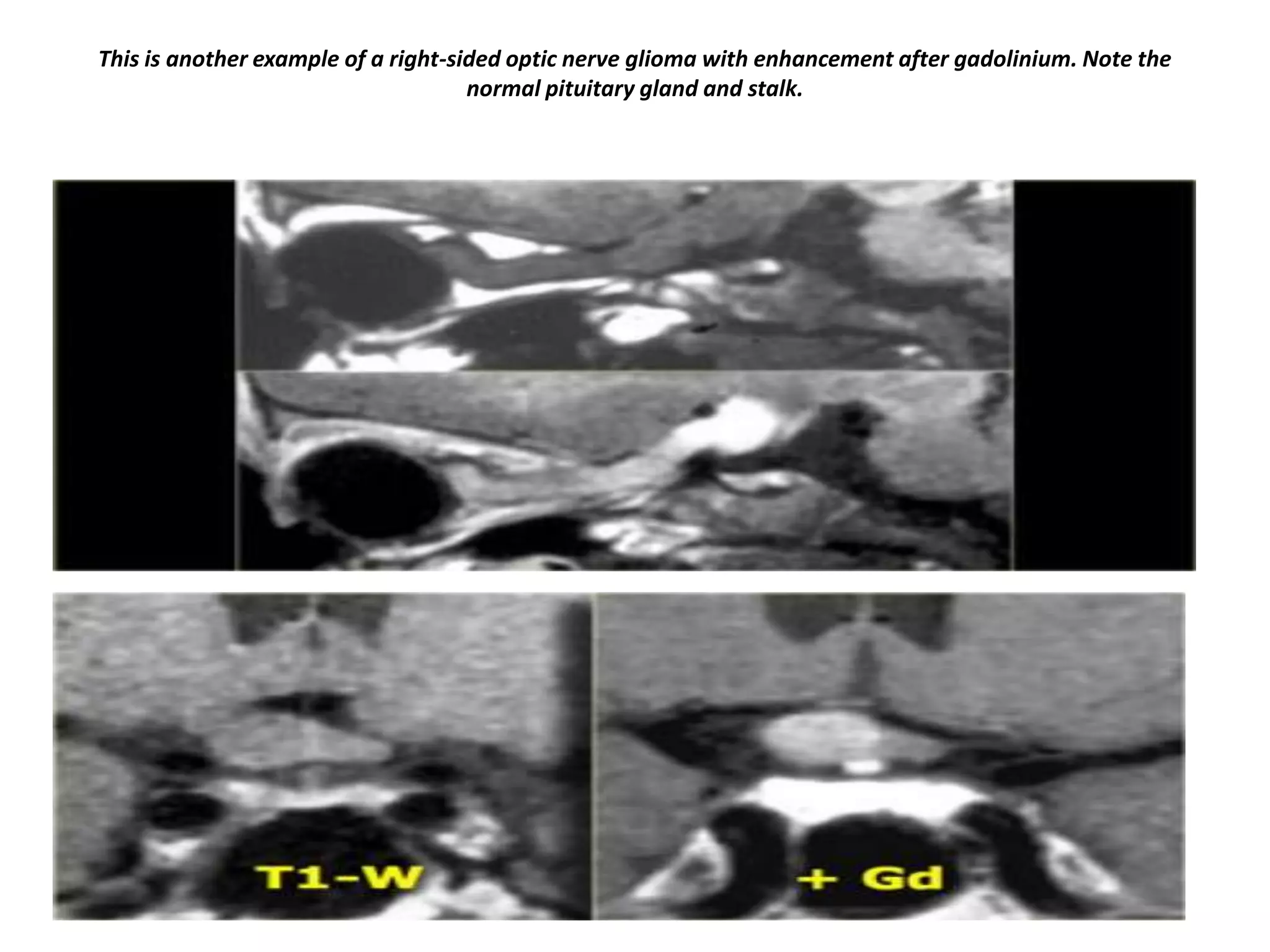 This is another example of a right-sided optic nerve glioma with enhancement after gadolinium. Note the
normal pituitary gland and stalk.

 
