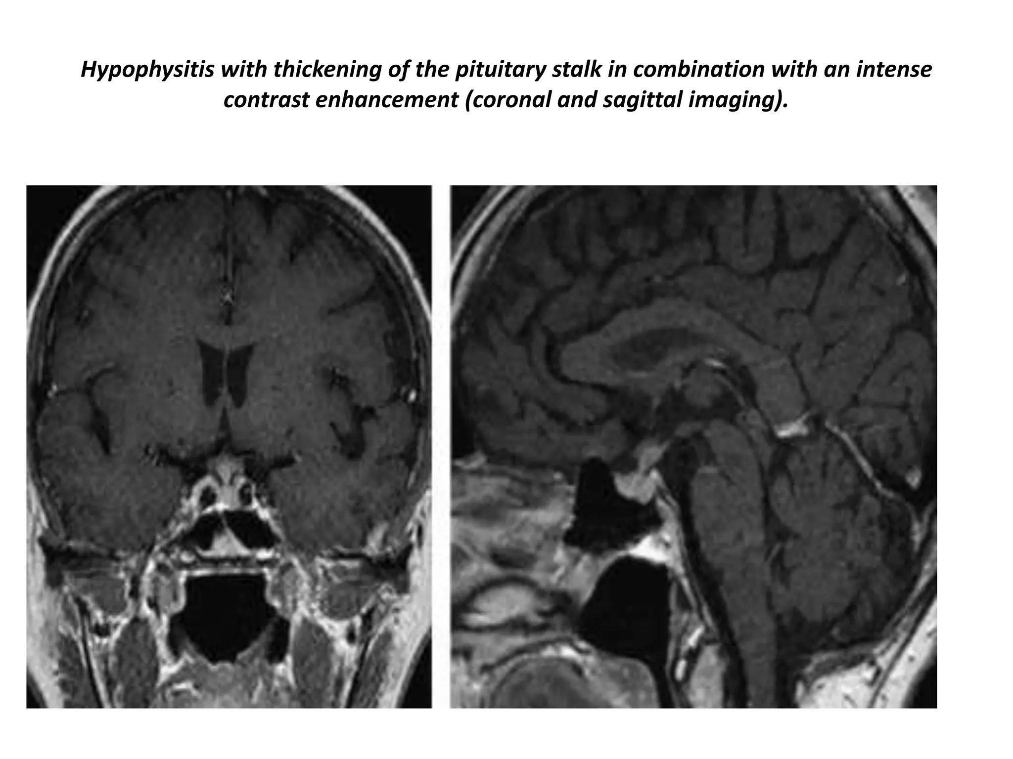 Hypophysitis with thickening of the pituitary stalk in combination with an intense
contrast enhancement (coronal and sagittal imaging).

 