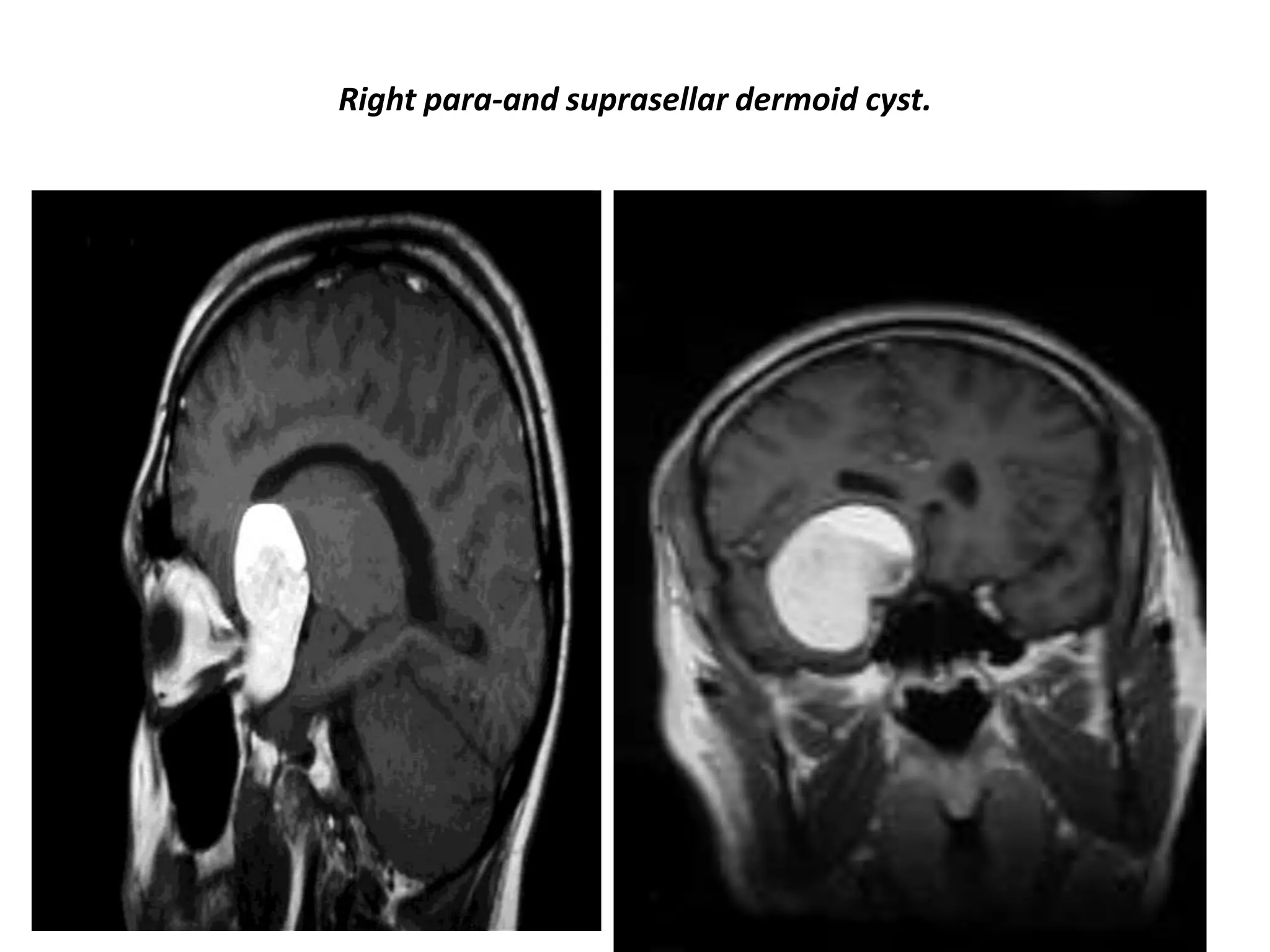 Right para-and suprasellar dermoid cyst.

 