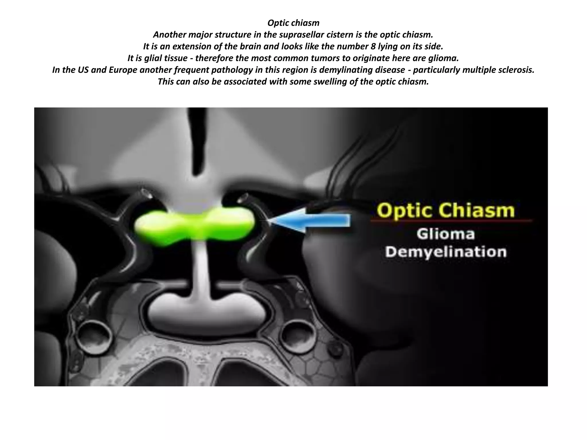 Optic chiasm
Another major structure in the suprasellar cistern is the optic chiasm.
It is an extension of the brain and looks like the number 8 lying on its side.
It is glial tissue - therefore the most common tumors to originate here are glioma.
In the US and Europe another frequent pathology in this region is demylinating disease - particularly multiple sclerosis.
This can also be associated with some swelling of the optic chiasm.

 