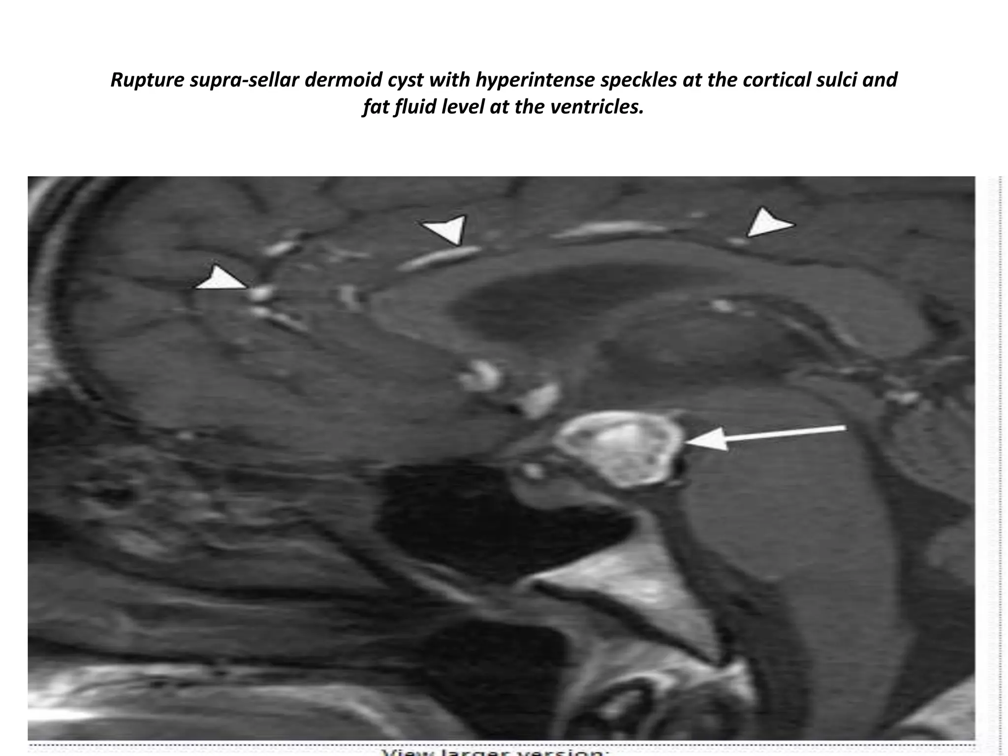 Rupture supra-sellar dermoid cyst with hyperintense speckles at the cortical sulci and
fat fluid level at the ventricles.

 