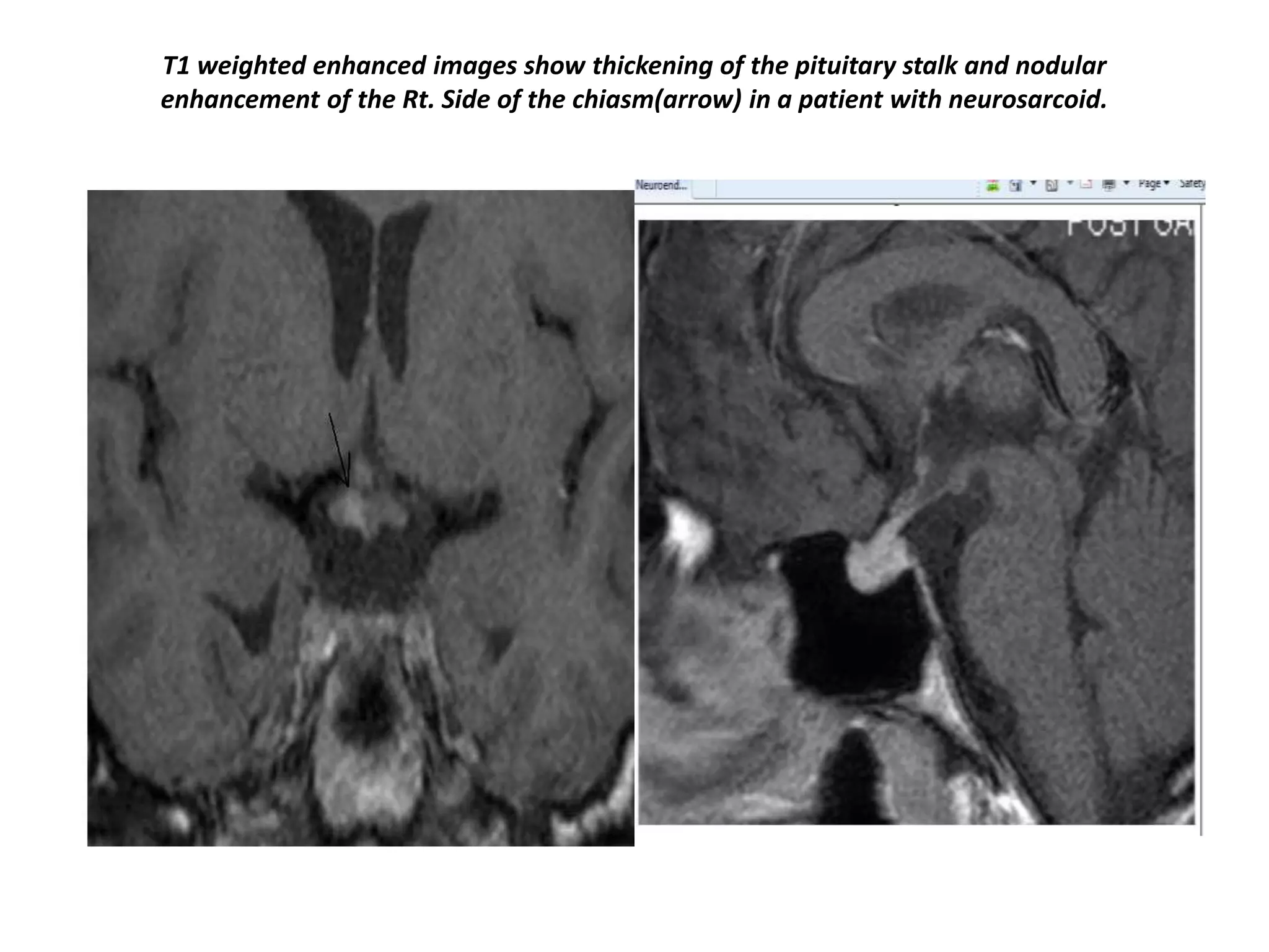 T1 weighted enhanced images show thickening of the pituitary stalk and nodular
enhancement of the Rt. Side of the chiasm(arrow) in a patient with neurosarcoid.

 