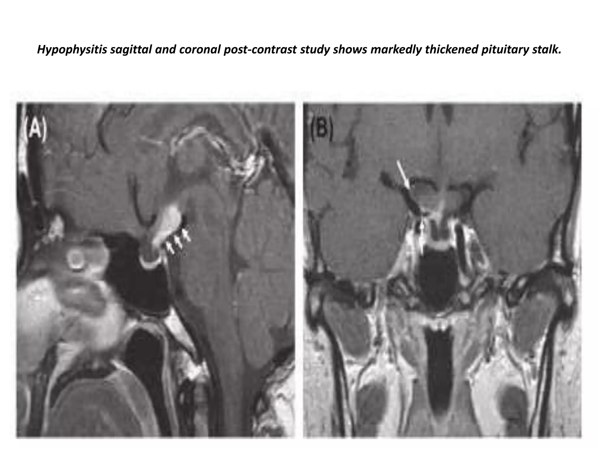 Hypophysitis sagittal and coronal post-contrast study shows markedly thickened pituitary stalk.

 