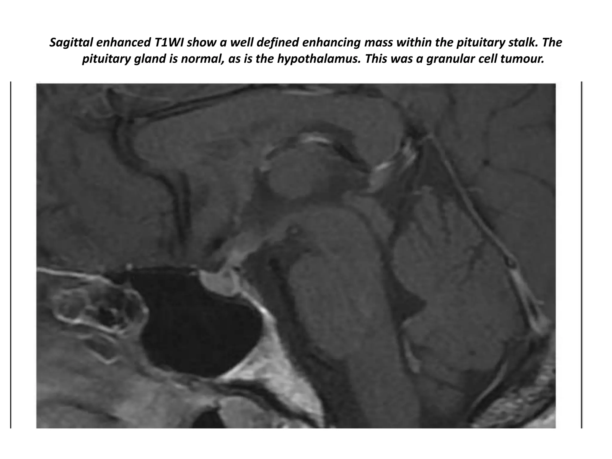 Sagittal enhanced T1WI show a well defined enhancing mass within the pituitary stalk. The
pituitary gland is normal, as is the hypothalamus. This was a granular cell tumour.

 