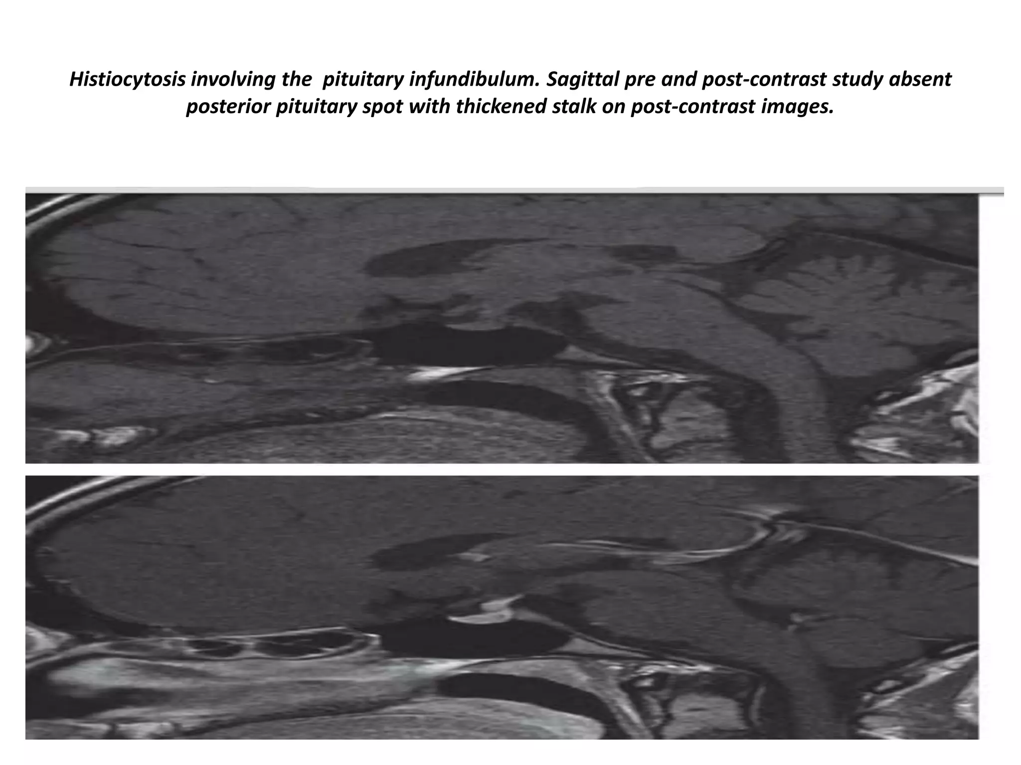 Histiocytosis involving the pituitary infundibulum. Sagittal pre and post-contrast study absent
posterior pituitary spot with thickened stalk on post-contrast images.

 