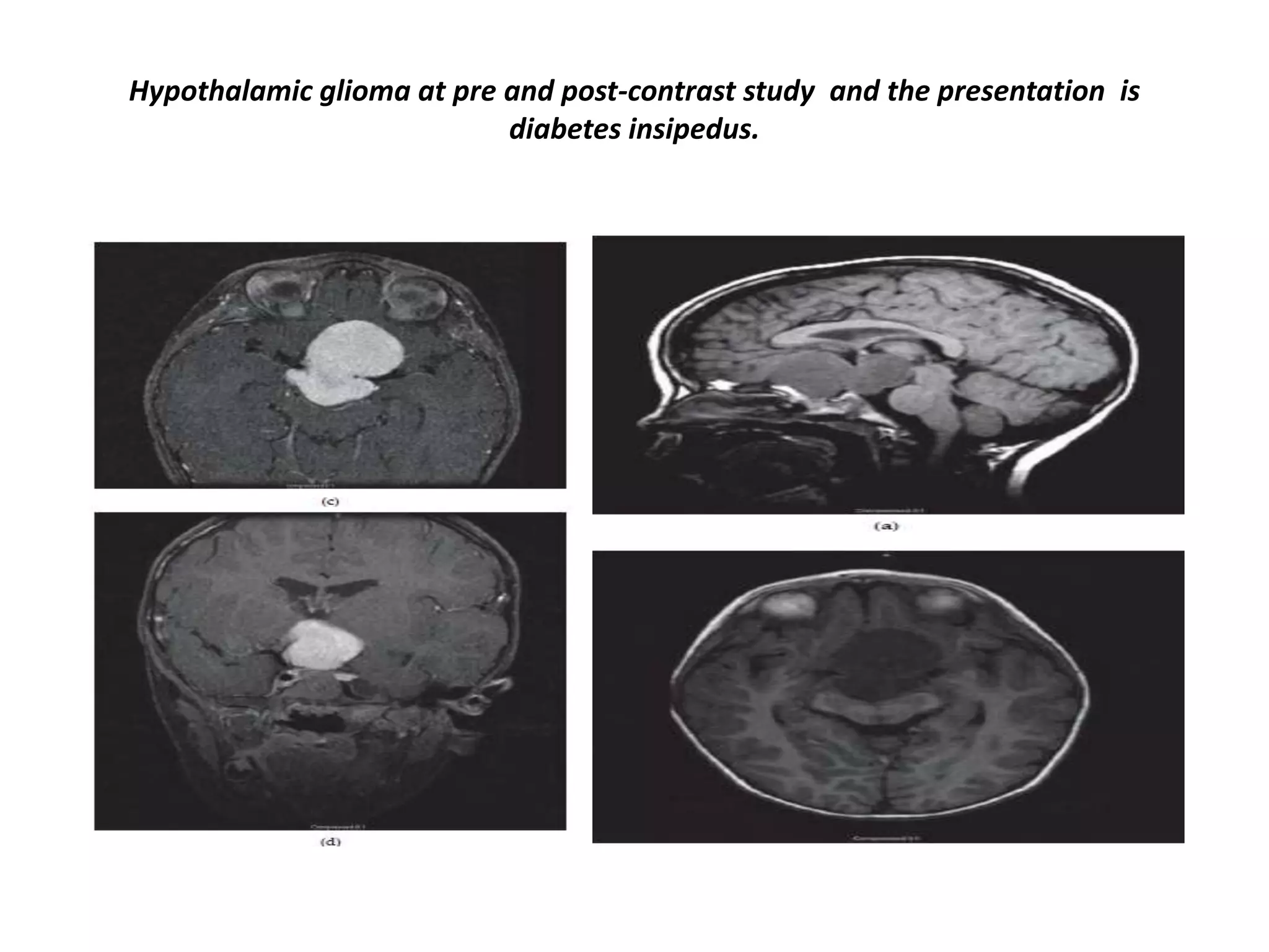 Hypothalamic glioma at pre and post-contrast study and the presentation is
diabetes insipedus.

 