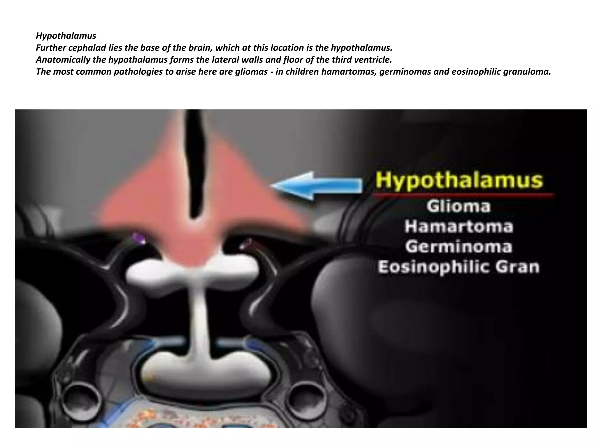 Hypothalamus
Further cephalad lies the base of the brain, which at this location is the hypothalamus.
Anatomically the hypothalamus forms the lateral walls and floor of the third ventricle.
The most common pathologies to arise here are gliomas - in children hamartomas, germinomas and eosinophilic granuloma.

 