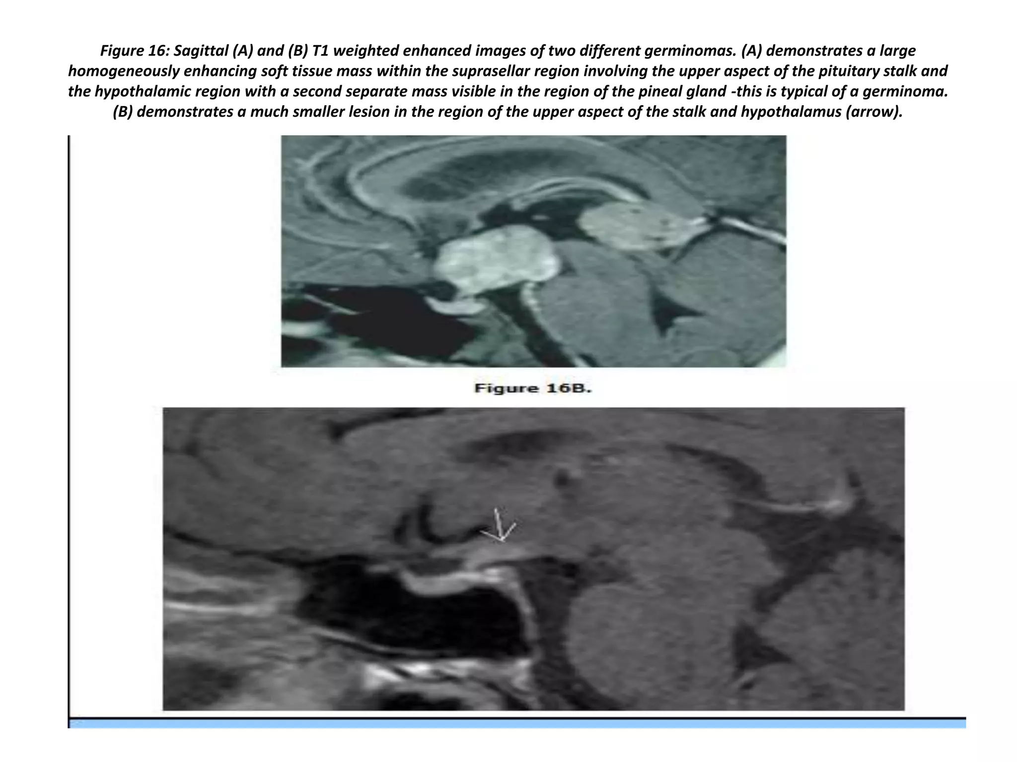Figure 16: Sagittal (A) and (B) T1 weighted enhanced images of two different germinomas. (A) demonstrates a large
homogeneously enhancing soft tissue mass within the suprasellar region involving the upper aspect of the pituitary stalk and
the hypothalamic region with a second separate mass visible in the region of the pineal gland -this is typical of a germinoma.
(B) demonstrates a much smaller lesion in the region of the upper aspect of the stalk and hypothalamus (arrow).

 