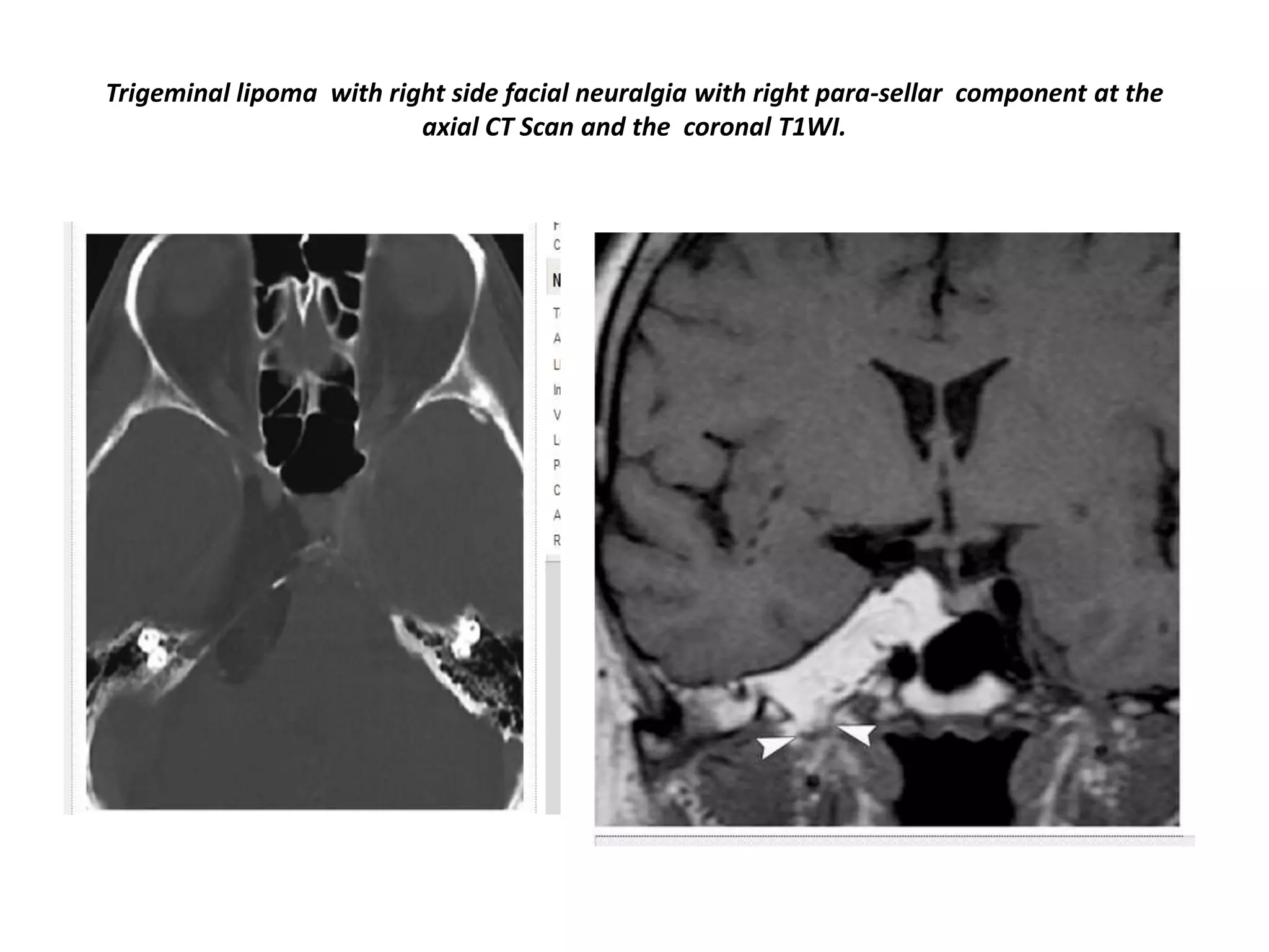 Trigeminal lipoma with right side facial neuralgia with right para-sellar component at the
axial CT Scan and the coronal T1WI.

 