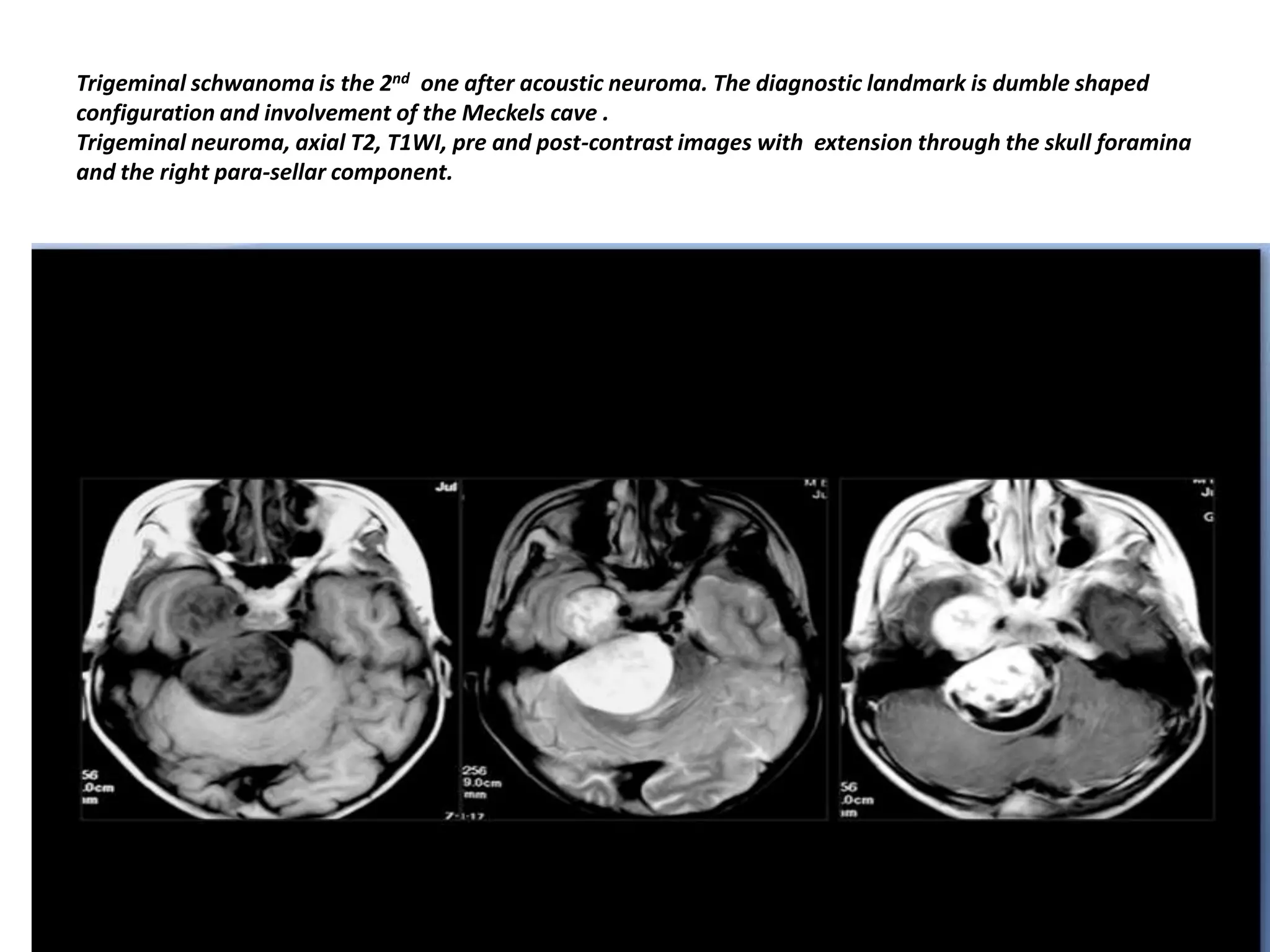 Trigeminal schwanoma is the 2nd one after acoustic neuroma. The diagnostic landmark is dumble shaped
configuration and involvement of the Meckels cave .
Trigeminal neuroma, axial T2, T1WI, pre and post-contrast images with extension through the skull foramina
and the right para-sellar component.

 