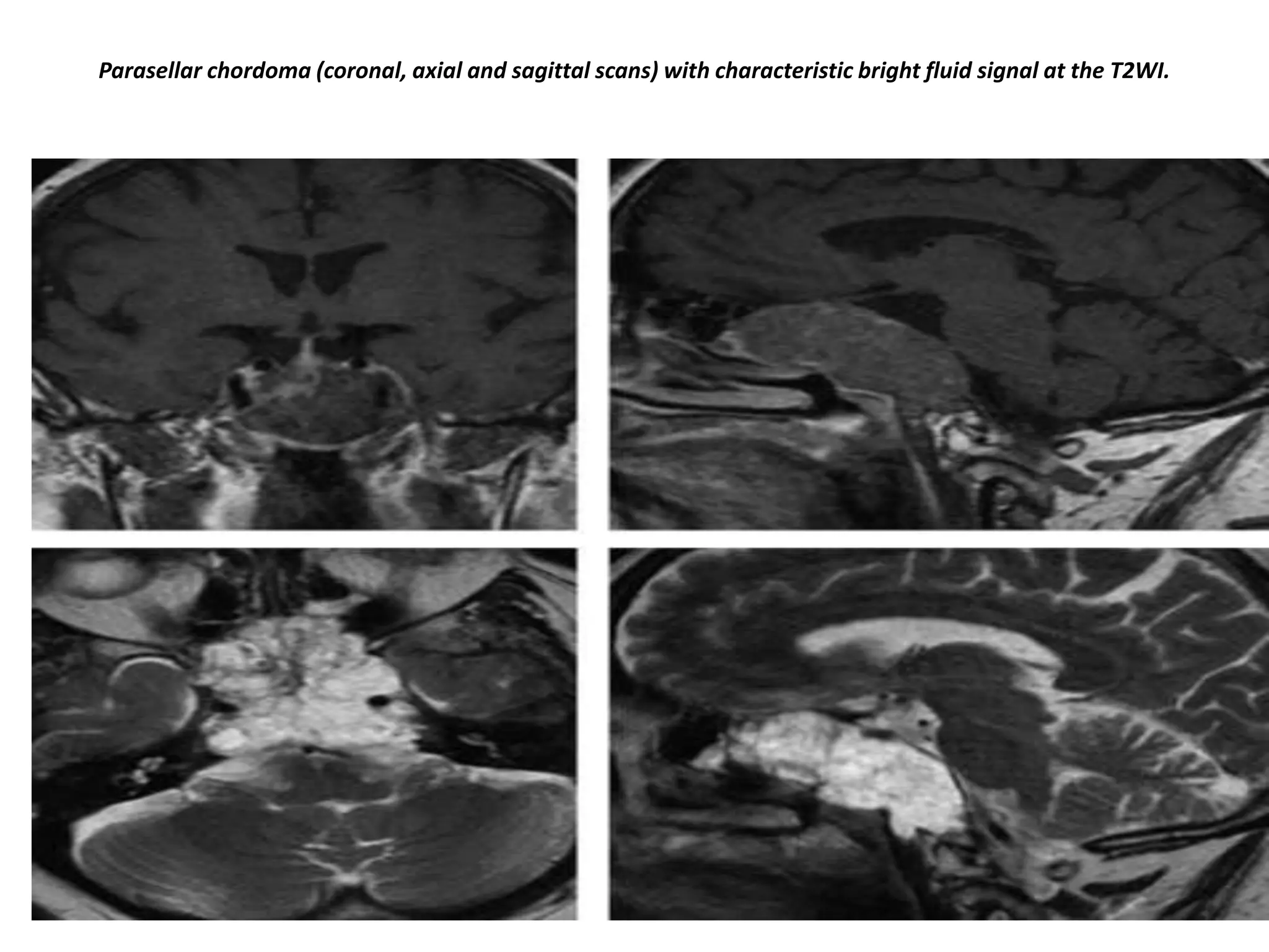 Parasellar chordoma (coronal, axial and sagittal scans) with characteristic bright fluid signal at the T2WI.

 
