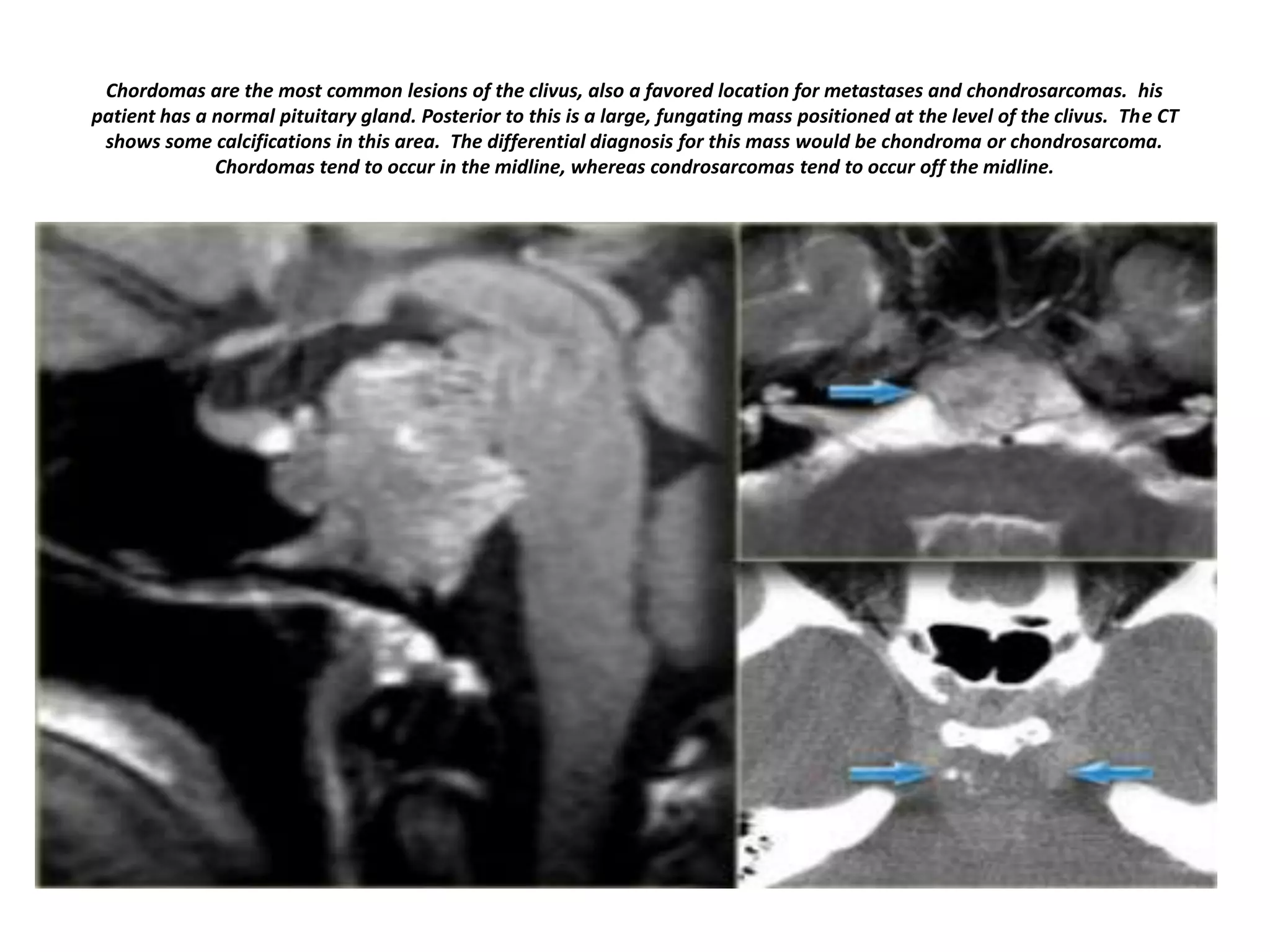 Chordomas are the most common lesions of the clivus, also a favored location for metastases and chondrosarcomas. his
patient has a normal pituitary gland. Posterior to this is a large, fungating mass positioned at the level of the clivus. The CT
shows some calcifications in this area. The differential diagnosis for this mass would be chondroma or chondrosarcoma.
Chordomas tend to occur in the midline, whereas condrosarcomas tend to occur off the midline.

 