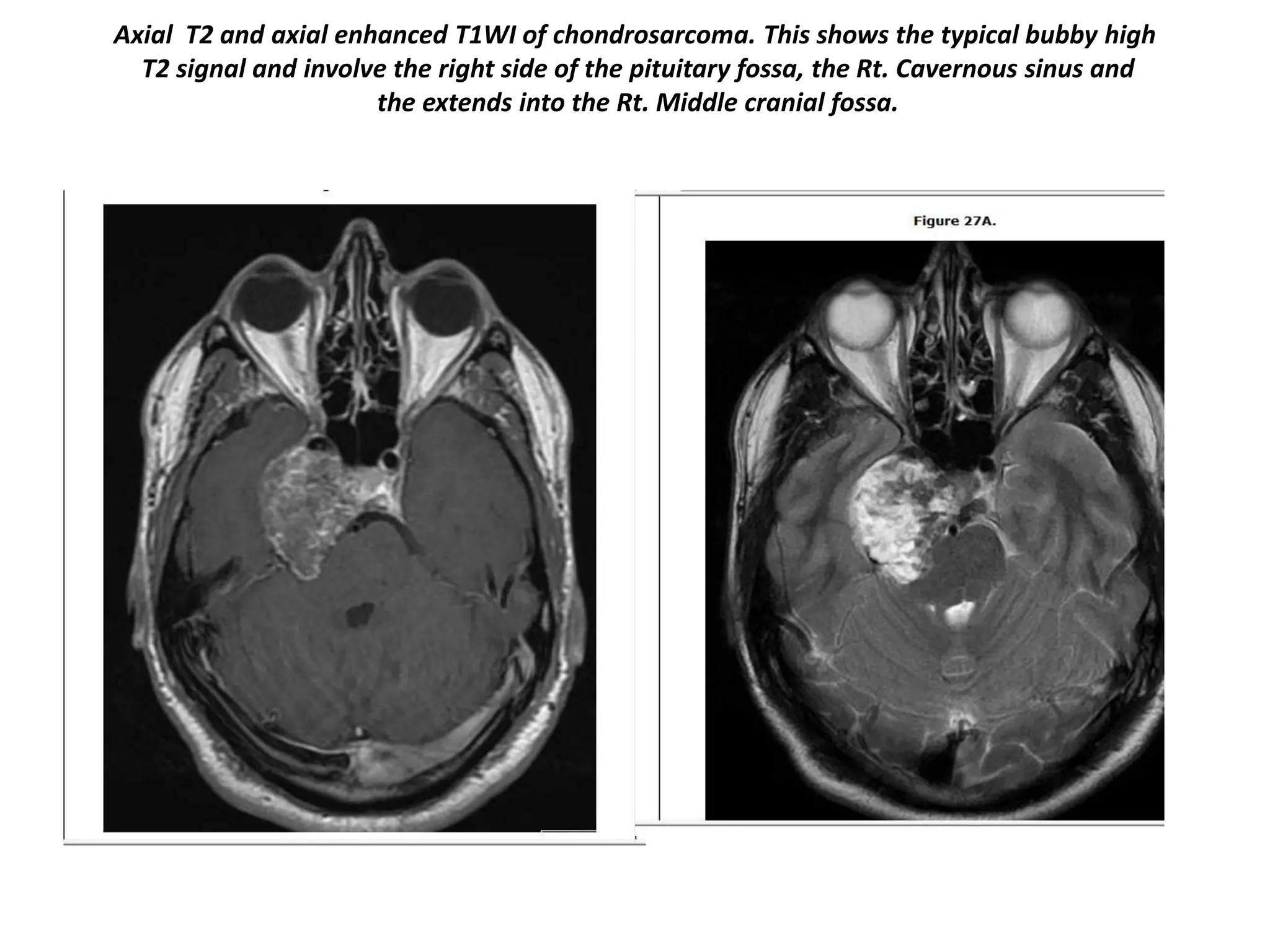 Axial T2 and axial enhanced T1WI of chondrosarcoma. This shows the typical bubby high
T2 signal and involve the right side of the pituitary fossa, the Rt. Cavernous sinus and
the extends into the Rt. Middle cranial fossa.

 