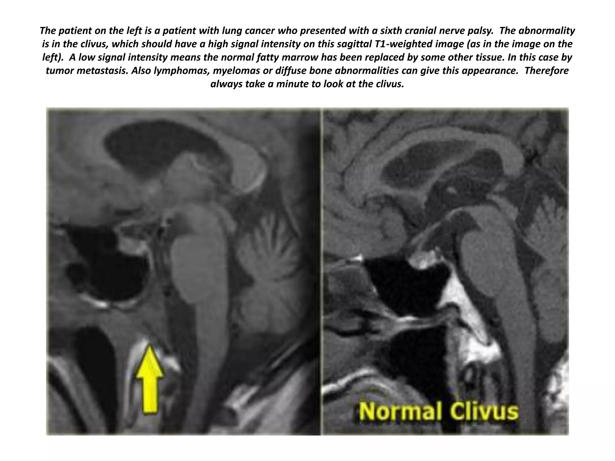 The patient on the left is a patient with lung cancer who presented with a sixth cranial nerve palsy. The abnormality
is in the clivus, which should have a high signal intensity on this sagittal T1-weighted image (as in the image on the
left). A low signal intensity means the normal fatty marrow has been replaced by some other tissue. In this case by
tumor metastasis. Also lymphomas, myelomas or diffuse bone abnormalities can give this appearance. Therefore
always take a minute to look at the clivus.

 