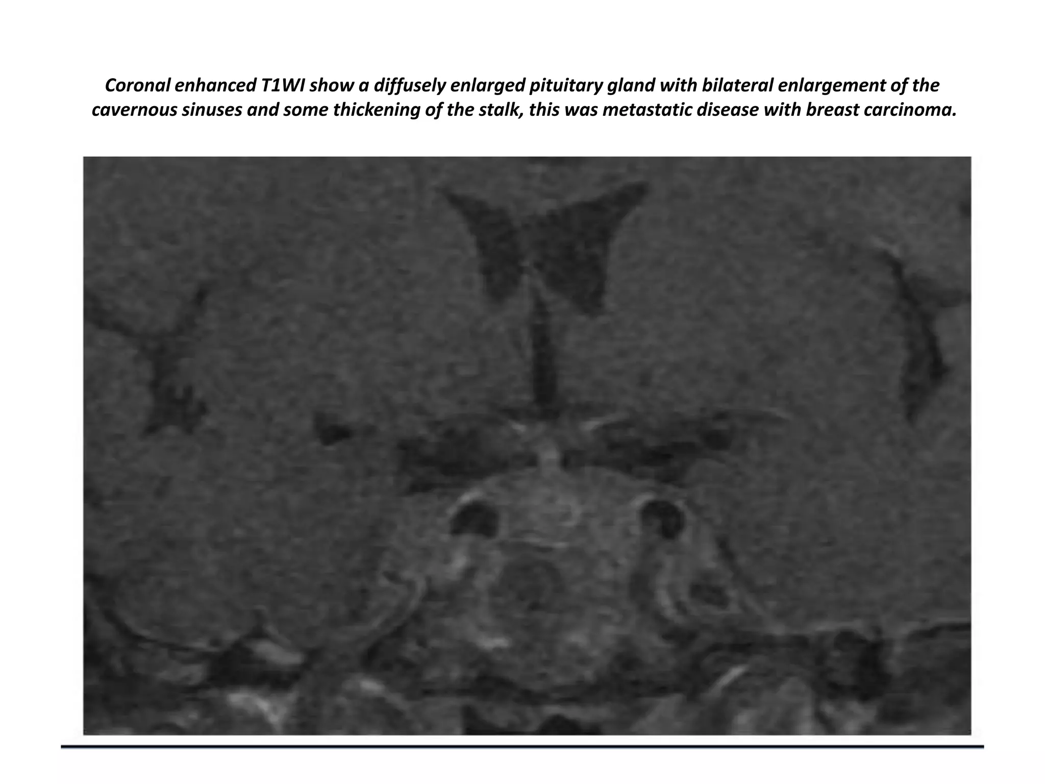 Coronal enhanced T1WI show a diffusely enlarged pituitary gland with bilateral enlargement of the
cavernous sinuses and some thickening of the stalk, this was metastatic disease with breast carcinoma.

 