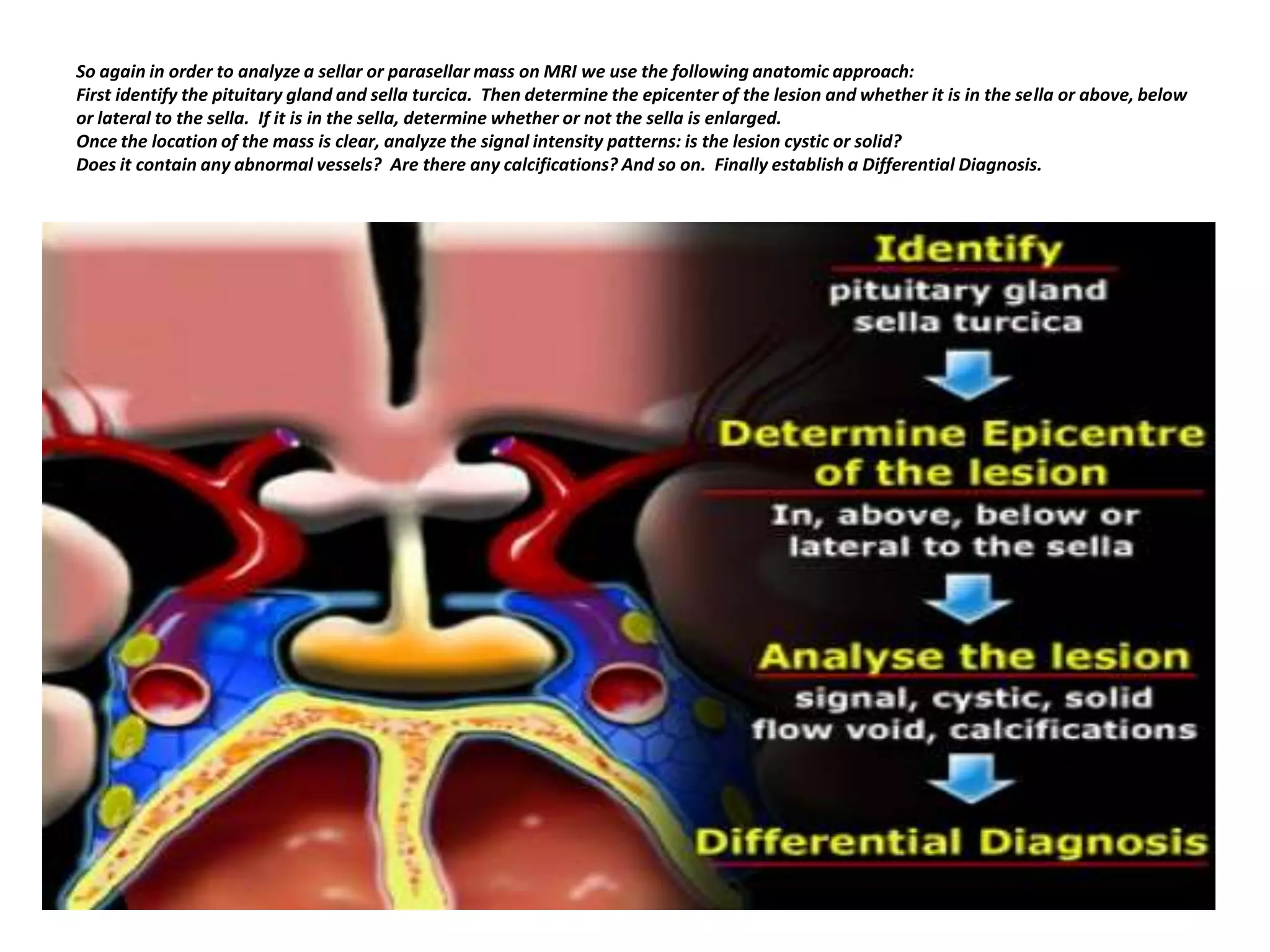 So again in order to analyze a sellar or parasellar mass on MRI we use the following anatomic approach:
First identify the pituitary gland and sella turcica. Then determine the epicenter of the lesion and whether it is in the sella or above, below
or lateral to the sella. If it is in the sella, determine whether or not the sella is enlarged.
Once the location of the mass is clear, analyze the signal intensity patterns: is the lesion cystic or solid?
Does it contain any abnormal vessels? Are there any calcifications? And so on. Finally establish a Differential Diagnosis.

 