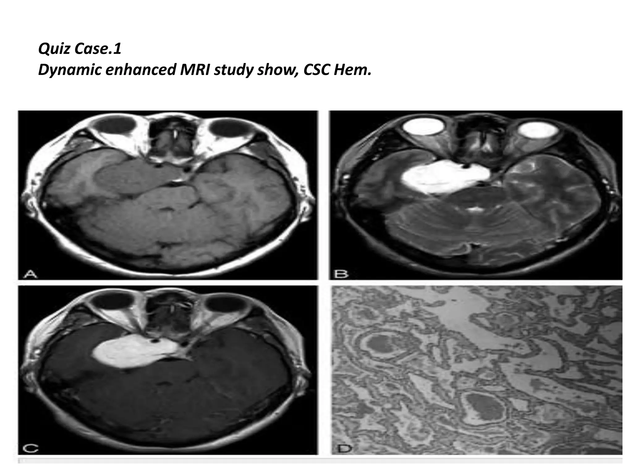 Quiz Case.1
Dynamic enhanced MRI study show, CSC Hem.

 