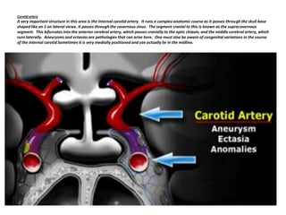 Carotid artery

A very important structure in this area is the internal carotid artery. It runs a complex anatomic course as it passes through the skull base
shaped like an S on lateral views. It passes through the cavernous sinus. The segment cranial to this is known as the supracavernous
segment. This bifurcates into the anterior cerebral artery, which passes cranially to the optic chiasm, and the middle cerebral artery, which
runs laterally. Aneurysms and ectasias are pathologies that can arise here. One must also be aware of congenital variations in the course
of the internal carotid Sometimes it is very medially positioned and can actually lie in the midline.

 