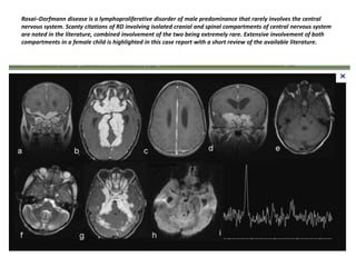 Rosai–Dorfmann disease is a lymphoproliferative disorder of male predominance that rarely involves the central
nervous system. Scanty citations of RD involving isolated cranial and spinal compartments of central nervous system
are noted in the literature, combined involvement of the two being extremely rare. Extensive involvement of both
compartments in a female child is highlighted in this case report with a short review of the available literature.

 