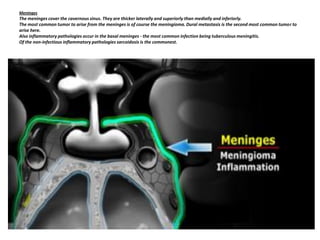 Meninges

The meninges cover the cavernous sinus. They are thicker laterally and superiorly than medially and inferiorly.
The most common tumor to arise from the meninges is of course the meningioma. Dural metastasis is the second most common tumor to
arise here.
Also inflammatory pathologies occur in the basal meninges - the most common infection being tuberculous meningitis.
Of the non-infectious inflammatory pathologies sarcoidosis is the commonest.

 