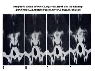 Empty sella shows infundibulum(Arrow head), and the pituitary
gland(Arrow), ICA(internal carotid artery), OC(optic chiasm).

 
