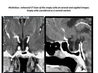 Multislices enhanced CT Scan of the empty sella at coronal and sagittal images.
Empty sella considered as a normal variant.

 